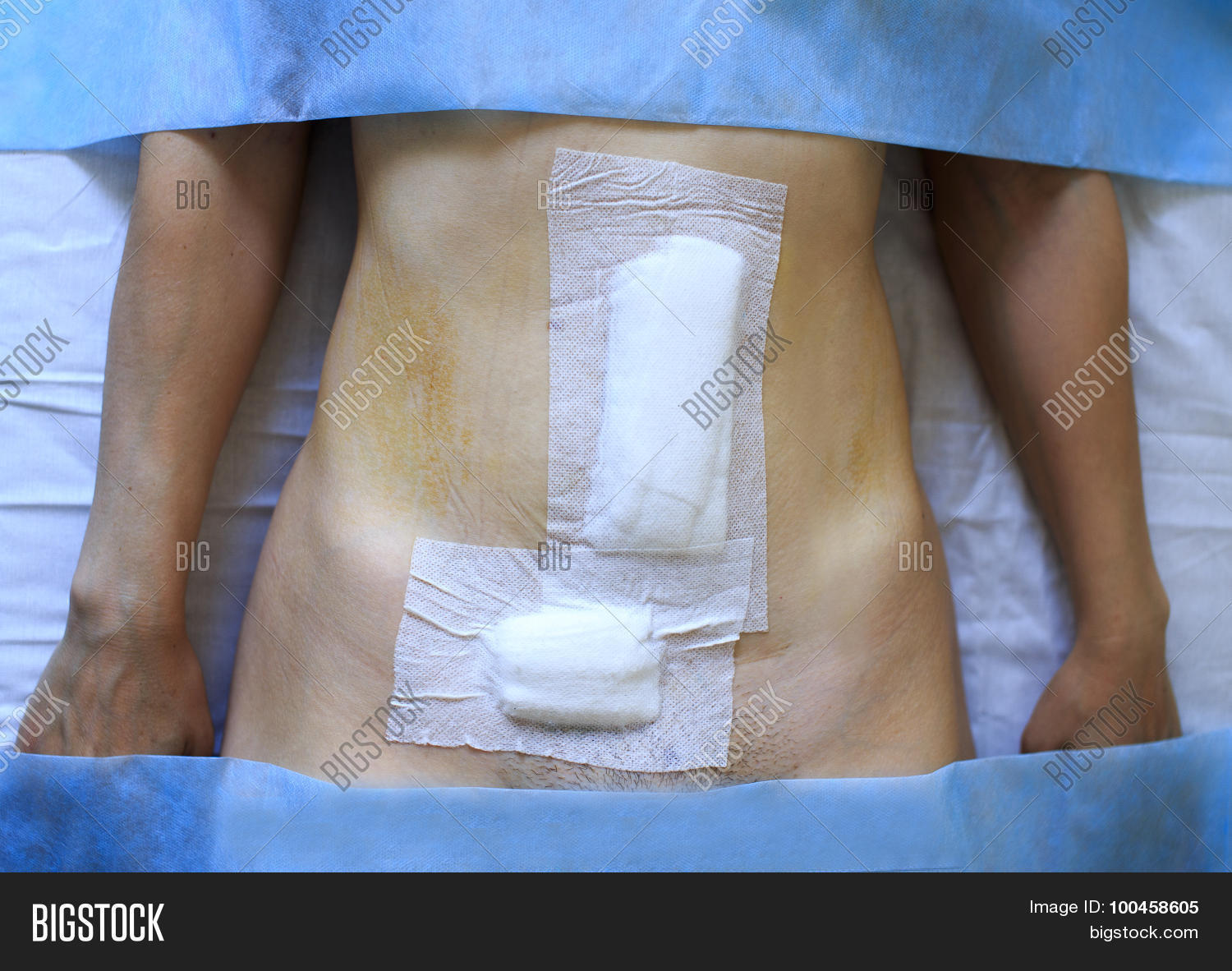 abdomen,abdominal,bandages,bandaging,belly,body,clinic,close-up,diastasis,dressing,healing,health,hernia,medicine,muscles,operating,patch,process,scars,stitches,supervision,surgeon,surgery,table,umbilical,woman,wound