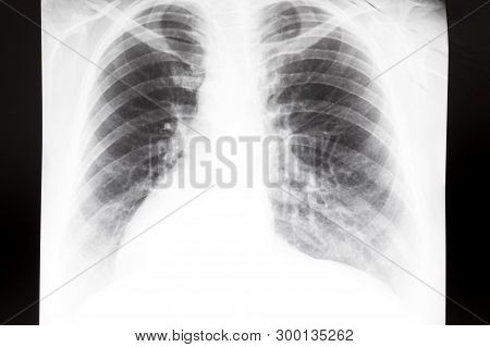 Front View Of Human Thorax With Lungs On X-ray Image image & stock ...
