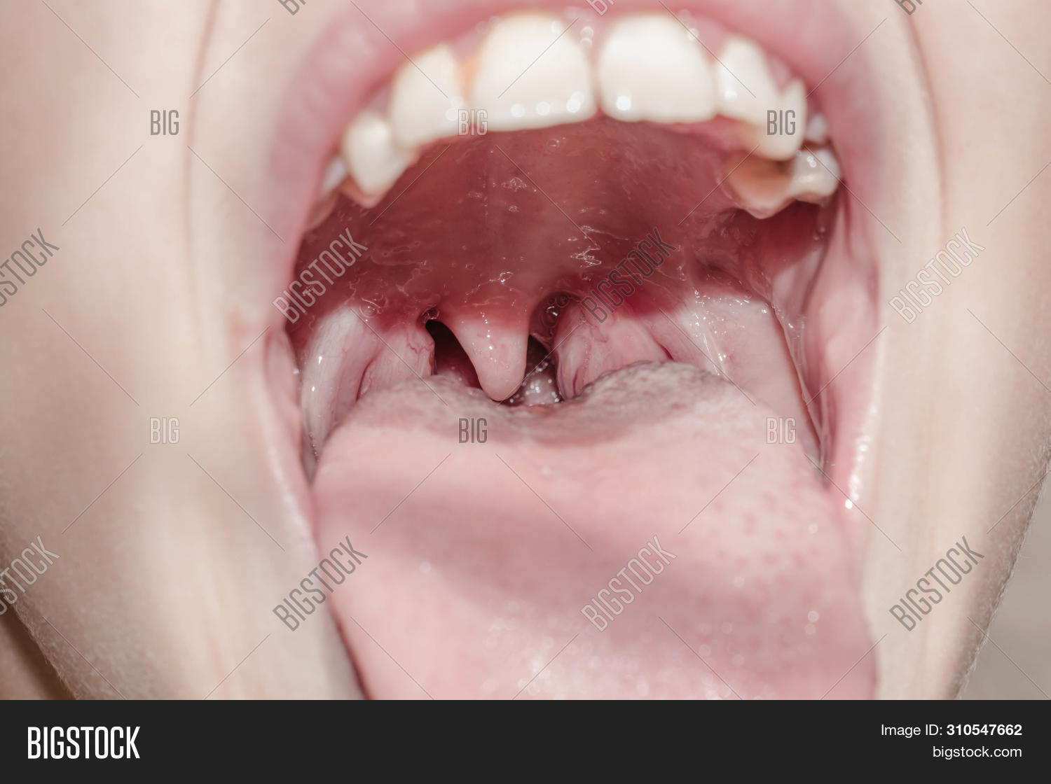 anatomy,bacteria,bacterial,care,closeup,dental,dentistry,disease,glands,health,healthy,human,illness,infection,inflamed,inflammation,laryngitis,larynx,lips,medical,medicine,mouth,of,open,oral,pain,pharyngitis,pharynx,respiratory,sore,strep,swollen,symptoms,teeth,the,throat,tongue,tonsil,tonsillitis,uvula,viral,virus,white