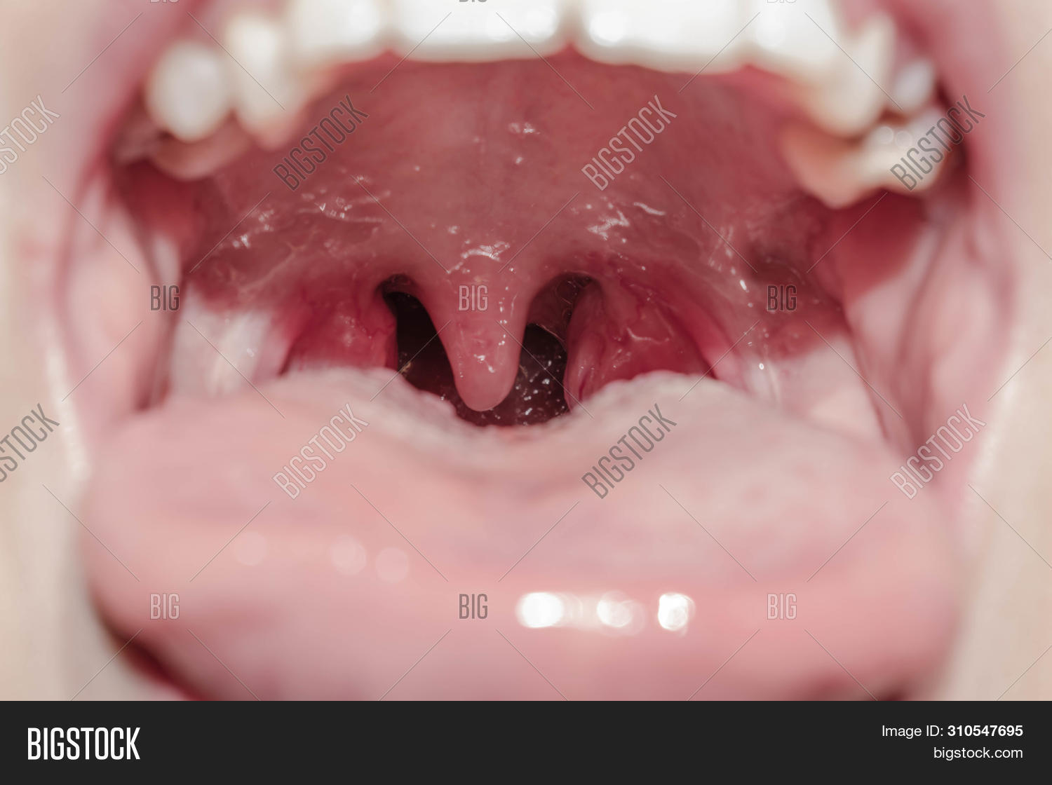 anatomy,bacteria,bacterial,care,closeup,dental,dentistry,disease,glands,health,healthy,human,illness,infection,inflamed,inflammation,laryngitis,larynx,lips,medical,medicine,mouth,of,open,oral,pain,pharyngitis,pharynx,respiratory,sore,strep,swollen,symptoms,teeth,the,throat,tongue,tonsil,tonsillitis,uvula,viral,virus,white
