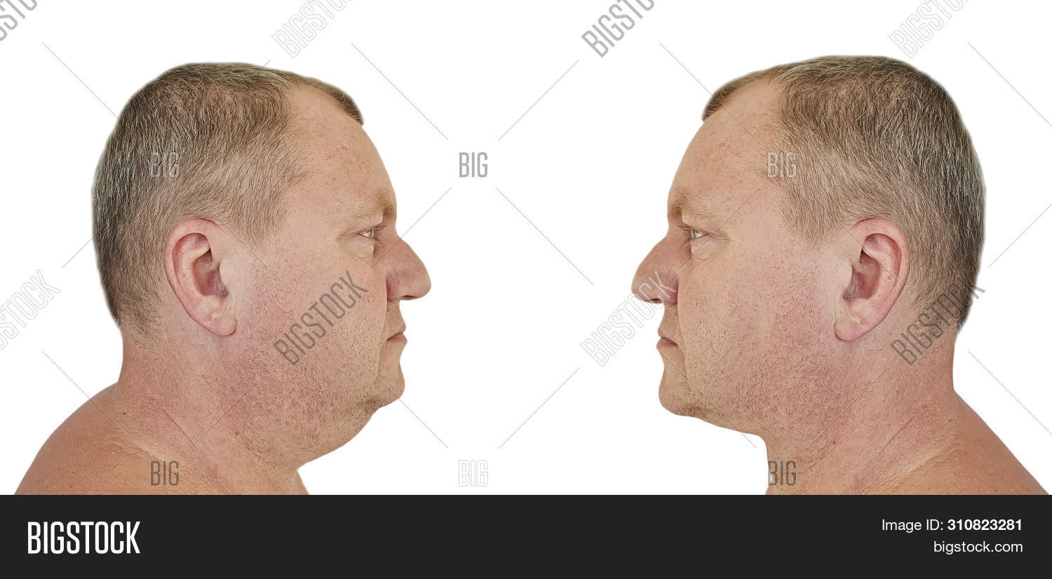 aesthetic,after,and,bad,before,big,chin,clinic,collage,correction,double,effect,excess,face,facelift,facial,fat,fille,head,human,injection,isolated,laser,lifestyle,lift,lifting,lipolytic,liposuction,loss,male,man,mature,medical,medicine,neck,obesity,oval,people,plastic,problem,procedure,removal,sagging,skin,slimming,surgery,tension,tightening,treatment,white