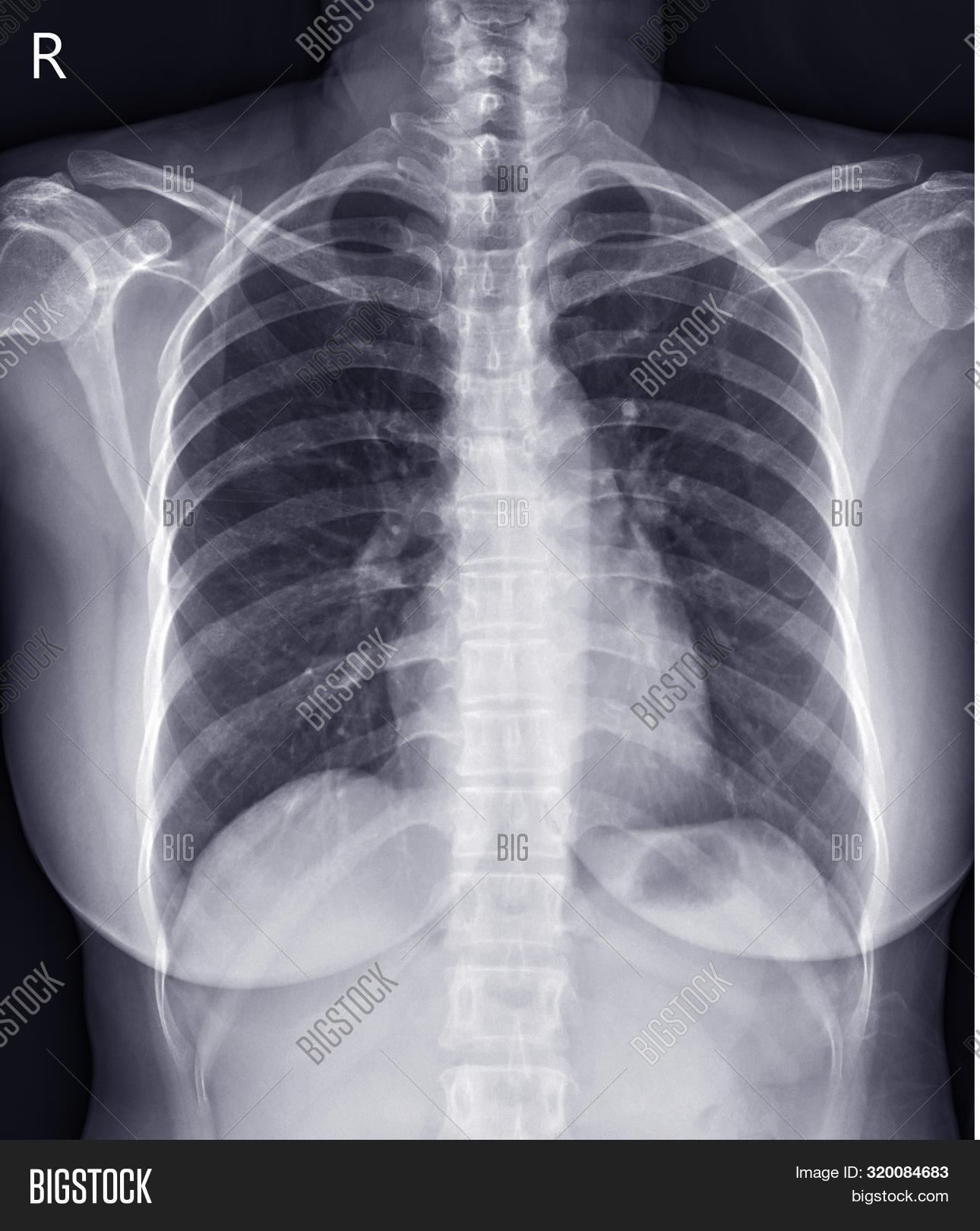 adult,anatomy,background,black,body,bone,care,checkup,chest,clavicle,diagnosis,disease,doctor,exam,examination,film,health,healthcare,healthy,heart,hospital,human,illness,image,isolated,lung,medical,medicine,normal,organ,orthopedic,patient,people,person,physician,pulmonary,radiation,radiograph,radiology,rib,scan,science,skeleton,spine,thoracic,thorax,white,x-ray,xray