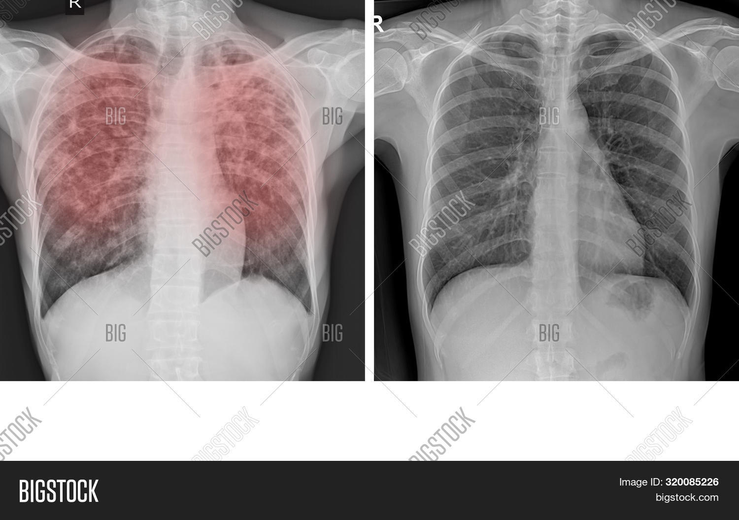 alveoli,alveolus,anatomy,antibiotic,asthma,bacillus,background,bacteria,biology,blood,body,breathe,bronchus,care,cell,chest,chronic,cough,disease,granuloma,health,healthy,history,human,illness,infection,latent,lung,medical,medicine,mycobacteria,mycobacterium,organ,pathology,patient,pneumonia,pulmonary,respiration,respiratory,sick,sputum,tb,thorax,tissue,trachea,treatment,tubercle,tuberculosis,x-ray