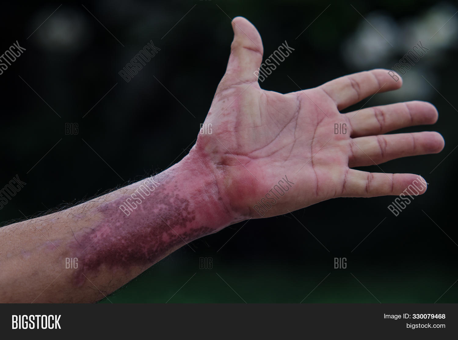 accident,arm,background,body,burn,care,cicatrice,cicatrix,closeup,doctor,fire,hand,heal,health,healthcare,heat,hospital,hot,human,hurt,illness,injury,man,medical,medicine,oil,operation,pain,painful,patient,people,person,red,rough,scar,scary,sick,skin,surgery,texture,tissue,treatment,wound