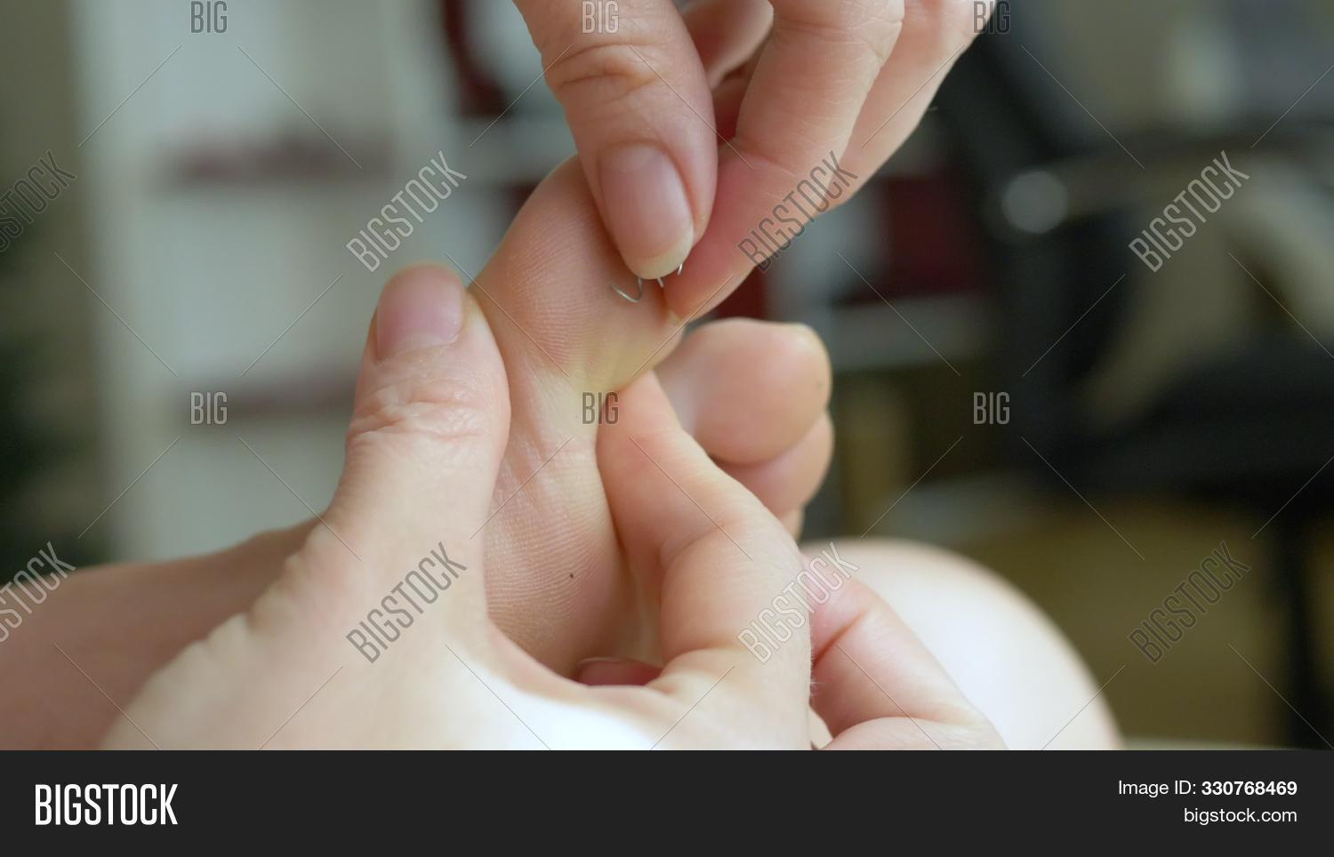 Splitter In The Foot. Close-up. A Female Hand Will Pull Out An Iron ...