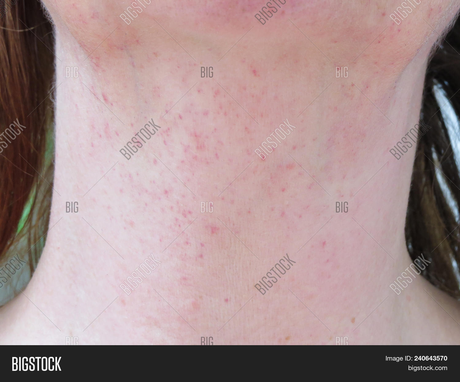 Petechiae,blemish,blemished,blood,burst,capillaries,care,chin,closeup,cluster,condition,coughing,dermatology,disorders,dots,fading,flat,health,human,ill,medical,neck,non-itchy,none,person,pinprick,pressure,problem,purpura,rash,red,redness,retching,sick,skin,spots,symptom,unhealthy,vessels,vomiting,woman