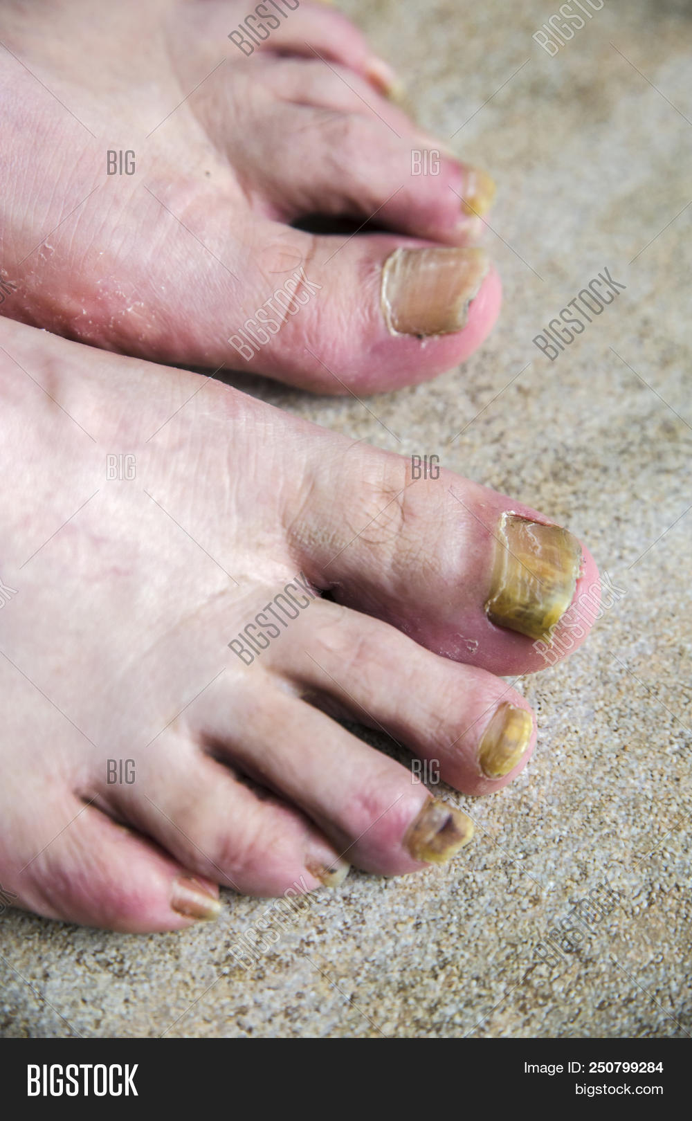 Onychomycosis With Fungal Nail Infection Two Feet Image Stock Photo Onychomycosis With Fungal Nail Infection Two Feet Image Stock Photo