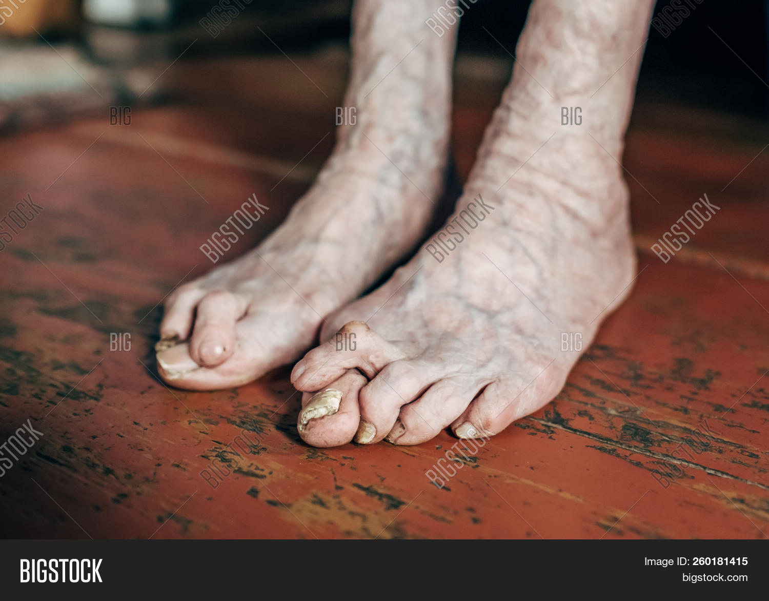 accident,anatomy,bare,big,bone,bump,bunion,care,caucasian,condition,deformation,deformed,deviation,diagnosis,disease,female,finger,floor,foot,gout,hallux,health,healthcare,human,hurt,illness,inflammation,injury,leg,medical,misalignment,nail,orthopedic,pain,patient,person,phalangeal,physical,problem,skin,swollen,tissue,toe,treatment,valgus,varicose,veins,white,woman,wooden