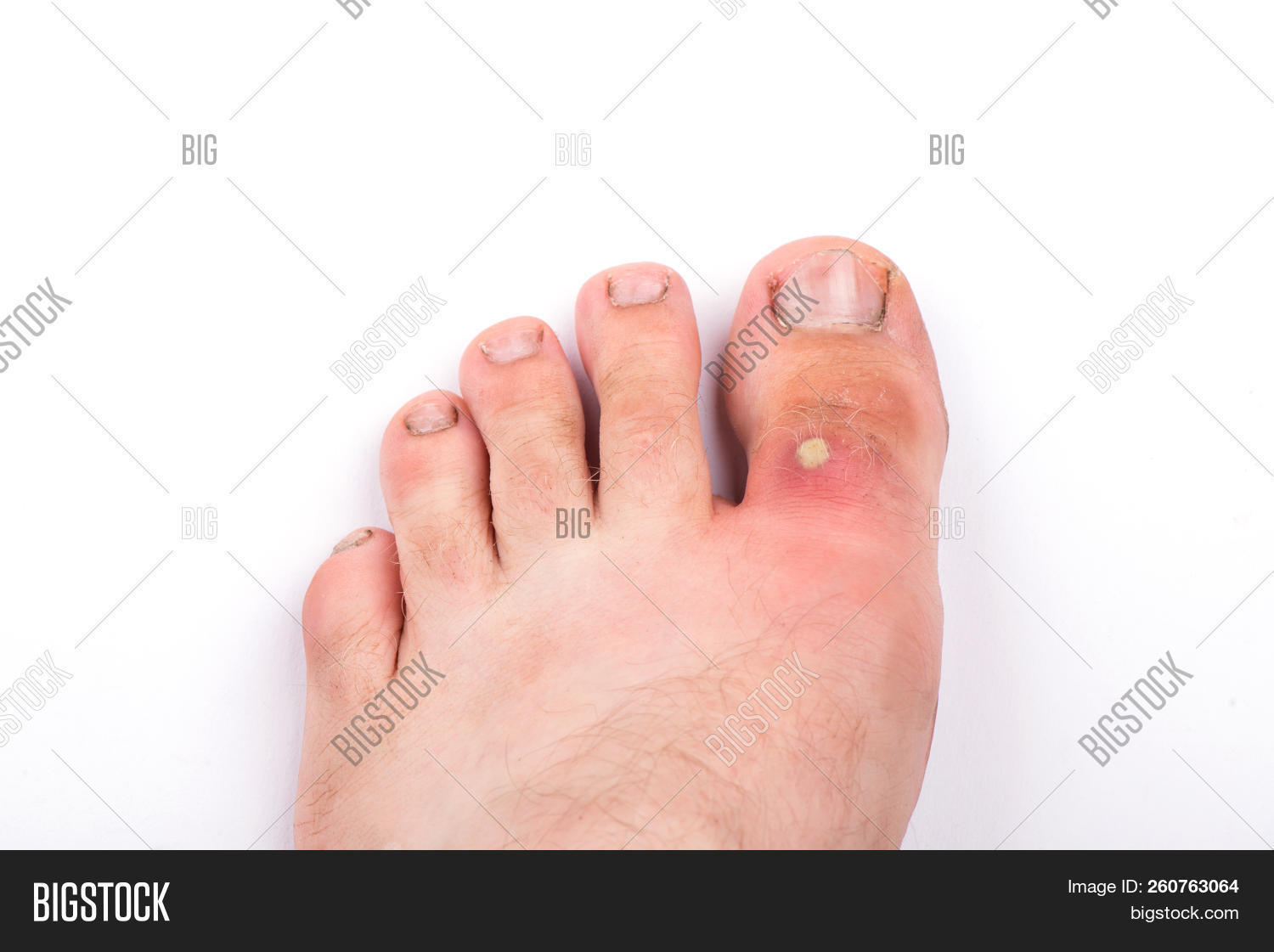 acne,anger,annoyance,annoying,background,blotch,body,care,close-up,closeup,dermatologist,dermatology,disease,eel,exasperation,feet,finger,foul,hair,health,healthy,human,hygiene,inflammation,irritation,isolated,leg,macro,man,matter,mattery,medical,medicine,pap,pedicure,people,pimple,purulent,pustule,red,skin,suppurate,toe,toenail,treatment,whelk,white,young
