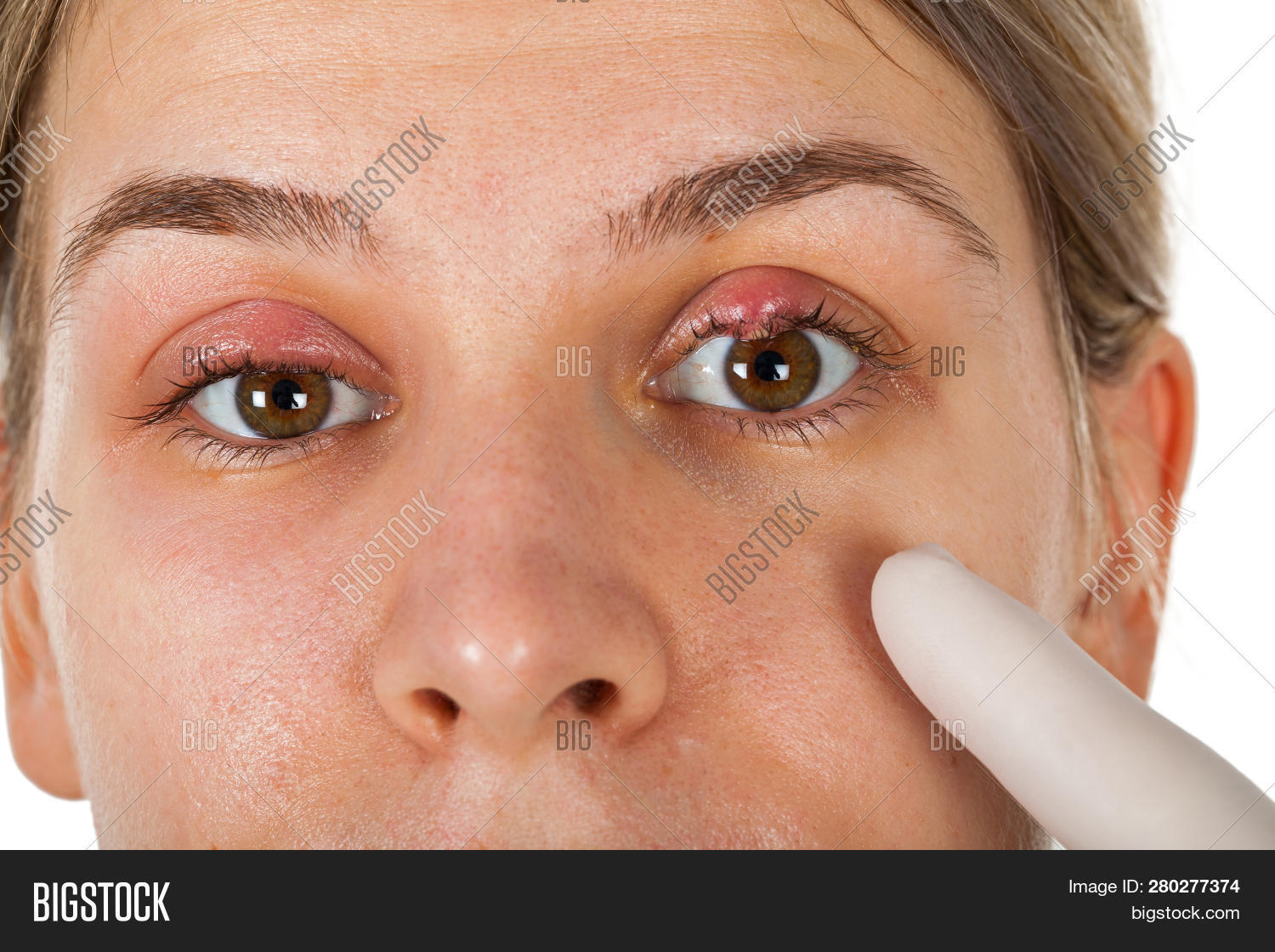 abscess,bacteria,barley,blepharitis,care,chalazion,conjunctivitis,cornea,curettage,disease,drainage,externum,eye,eyelid,face,female,germs,gland,hordeolosis,hordeolum,illness,incision,infection,inflammation,lid,macro,medical,nodule,ophthalmologist,optician,pain,painful,patient,pimples,purulent,pus,sebum,skin,staphylococcus,streptococcus,sty,stye,suppurative,symptom,tallow,tarsus,upper,virus,woman,young