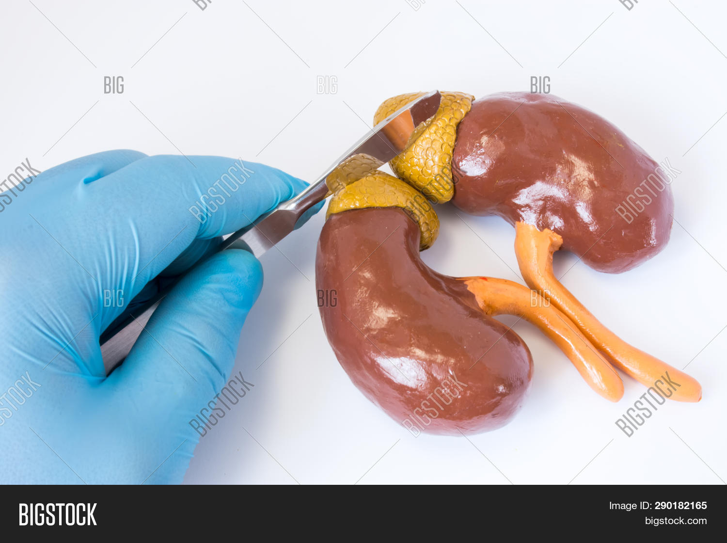 Adrenal Gland Surgery Concept Photo. 3d Anatomical Shape Of Adrenal
