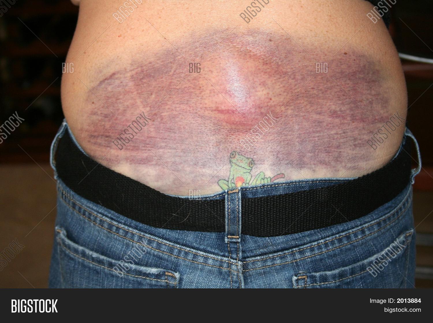 accident,back,belt,big,black,blue,bruise,bruising,bulge,bump,clinic,color,colorful,comfort,cry,crying,ct,ct scan,doctor,drugs,emergency,fall,fear,fell,female,fluid,frog,green,heal,healing,hematoma,hospital,hurt,impact,injured,injury,jean,lady,lower,medical,medicine,mri,nurse,pain,painful,patient,pressure,purple,relax,rest,scan,skin,sore,spread,spreading,swollen,tattoo,test,woman
