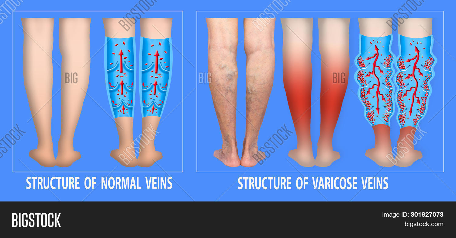 Varicose Veins On A Female Senior Legs. The Structure Of Normal And ...