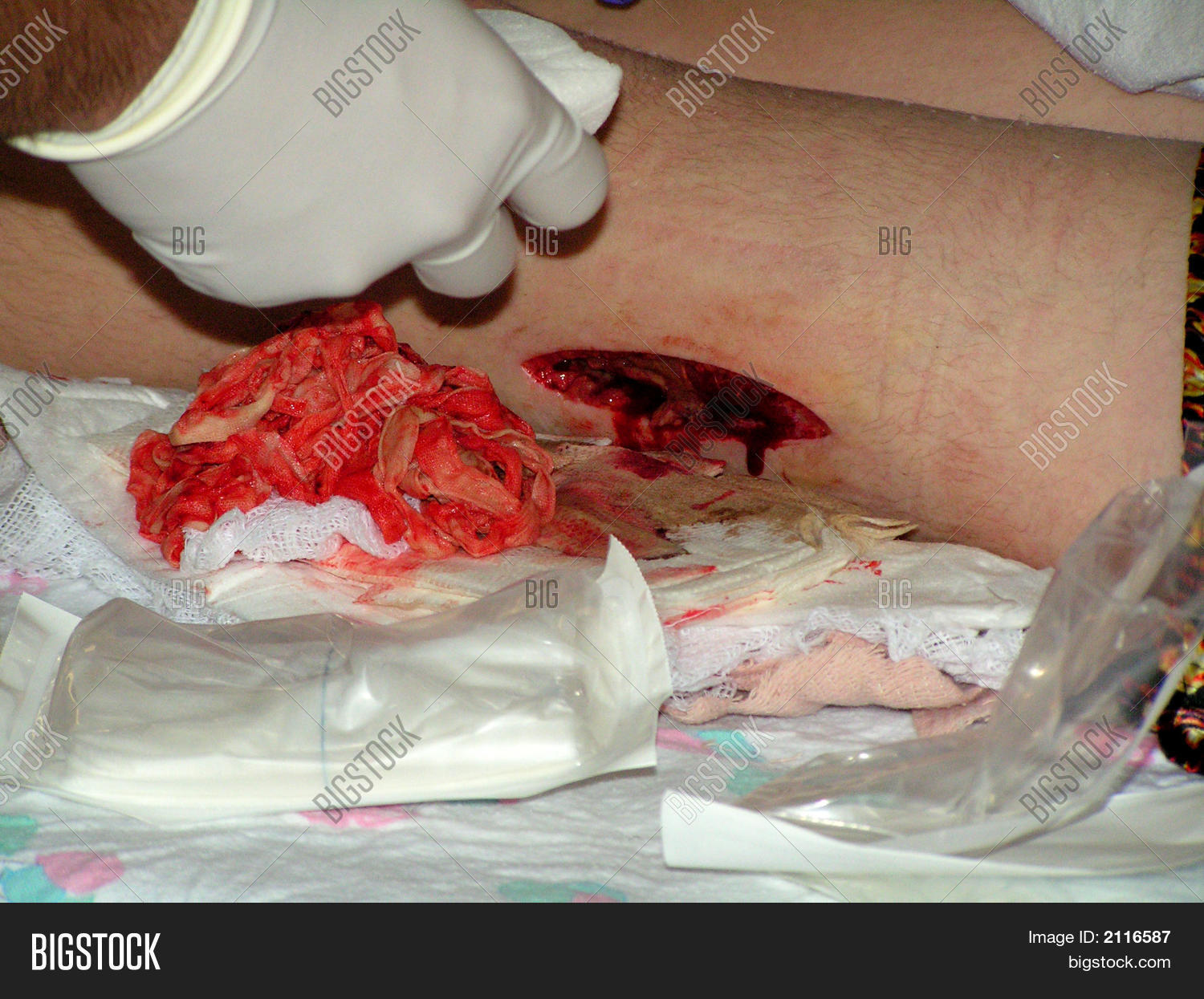 antibiotic,aureus,bacteria,biopsy,bone,boy,care,change,debridement,deep,drainage,dressing,extremity,femur,gauze,gloves,illness,incision,infection,injury,methicillin-resistant,mrsa,nursing,open,operating,operation,osteomyelitis,patient,person,prep,puss,resistant,soft,staph,sterile,surgeon,surgery,surgical,teen,teenager,tissue,tweezer,vancomycin,wound