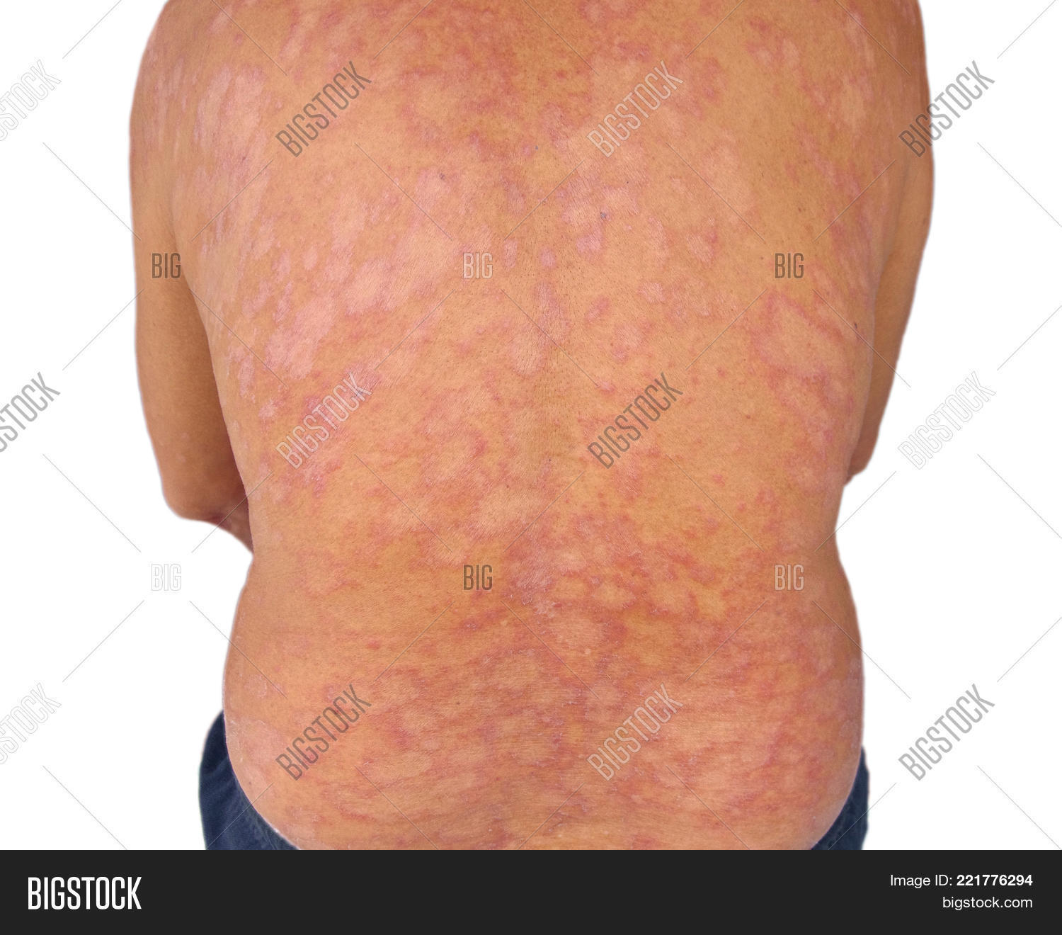 Allergic,Atopic,Cellulitis,Close-up,Erysipelas,Fungal,Mycosis,Pathogenic,Ringworm,Seborrtheic,Tinea,back,body,cancer,care,clean,concern,contact,corporis,cream,dermatitis,dermatology,disease,disorder,elbow,furuncles,health,hygiene,hypersensitivity,impetiongo,infection,macro,materials,medical,medicinal,panel,papules,party,patch,patient,peel,people,psoriasis,skin,test,treatment,ugly,white,worry,yeast