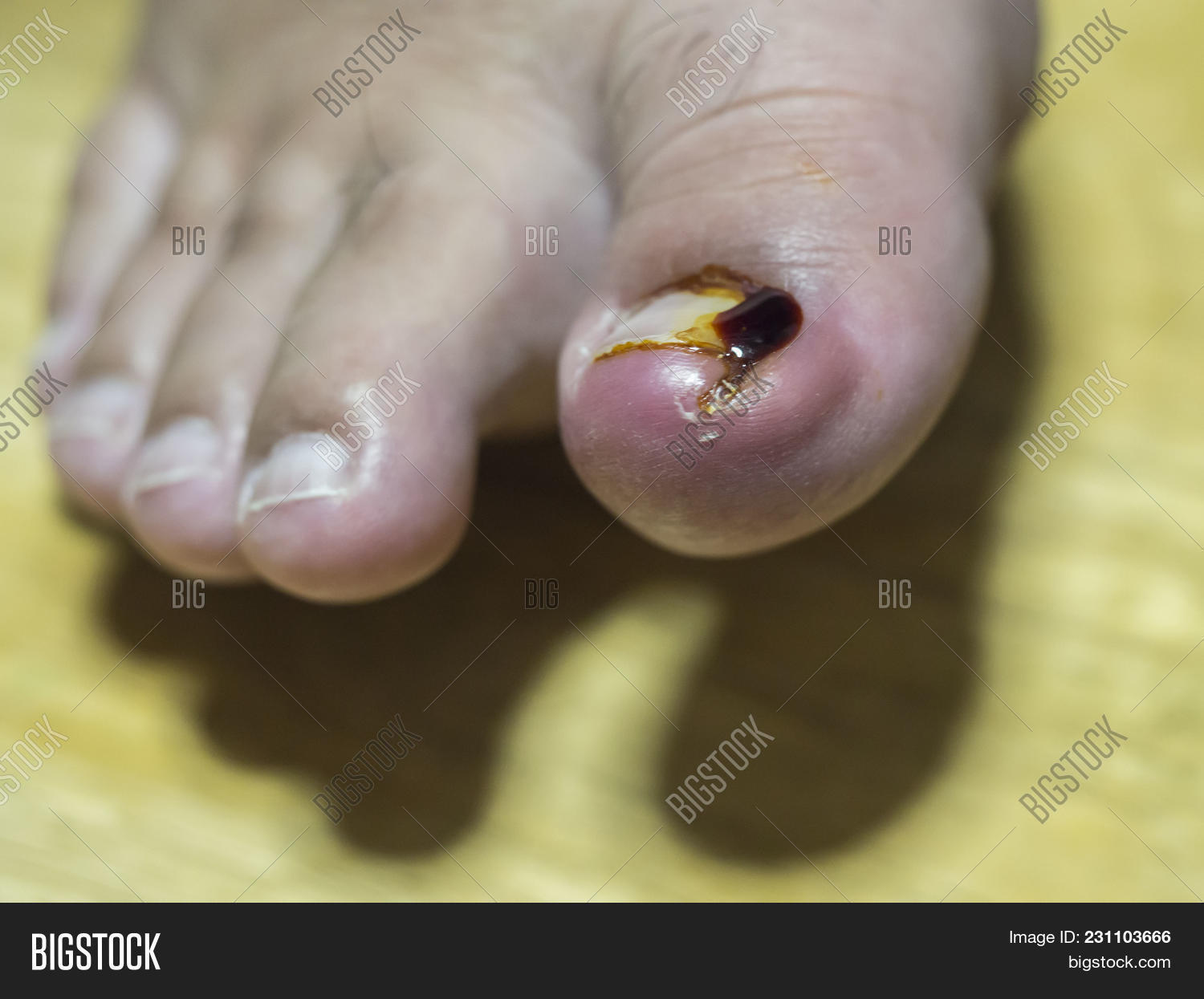 Macro,accident,agnail,bacteria,cracked,dermatologist,disease,doctor,finger,foot,fungus,health,healthy,herpes,infection,ingrown,injury,leg,medicine,nail,operation,overgrown,pain,painful,patient,pedicure,peeling,pus,shot,simply,skin,smell,surgeon,swelling,tissue,toe,toenail,treatment,ugly,wound