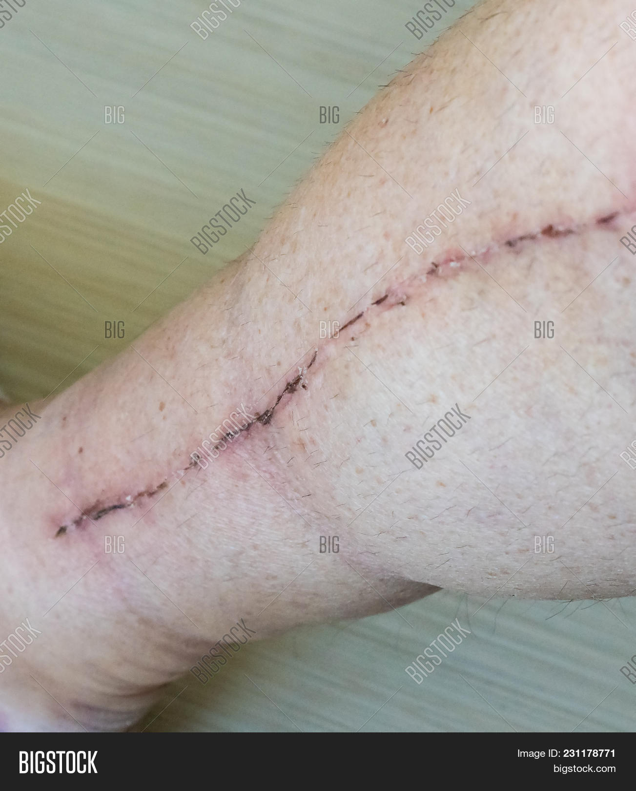 accident,angina,angioplasty,aorta,artery,blockage,body,breast,bypass,cardiac,care,chest,close,closeup,coronary,cut,damage,drain,elder,elderly,health,healthy,heart,hospital,human,hurt,illness,incision,injury,laceration,leg,male,medical,obstruction,old,open,pacemaker,pectoris,recovery,scar,skin,stenosis,strain,surgery,surgical,tissue,valve,vein
