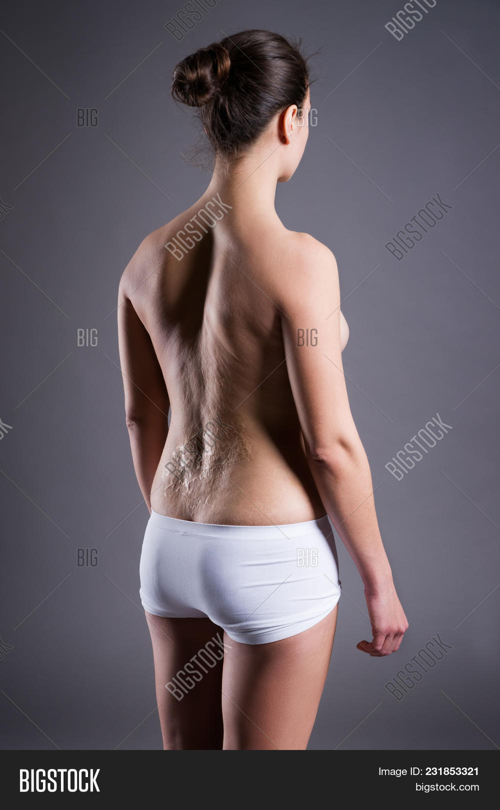 accident,aesthetic,affliction,after,back,beauty,body,burn,cicatrice,cicatrix,correction,damage,distress,female,harm,heal,health,human,hurt,illness,inability,infection,injury,keloid,large,lesion,medicine,operation,pain,painful,people,rear,recovery,removal,scars,shirtless,sick,skin,sore,surgery,surgical,tissue,topless,transplant,trauma,treatment,ugliness,ugly,woman,wound