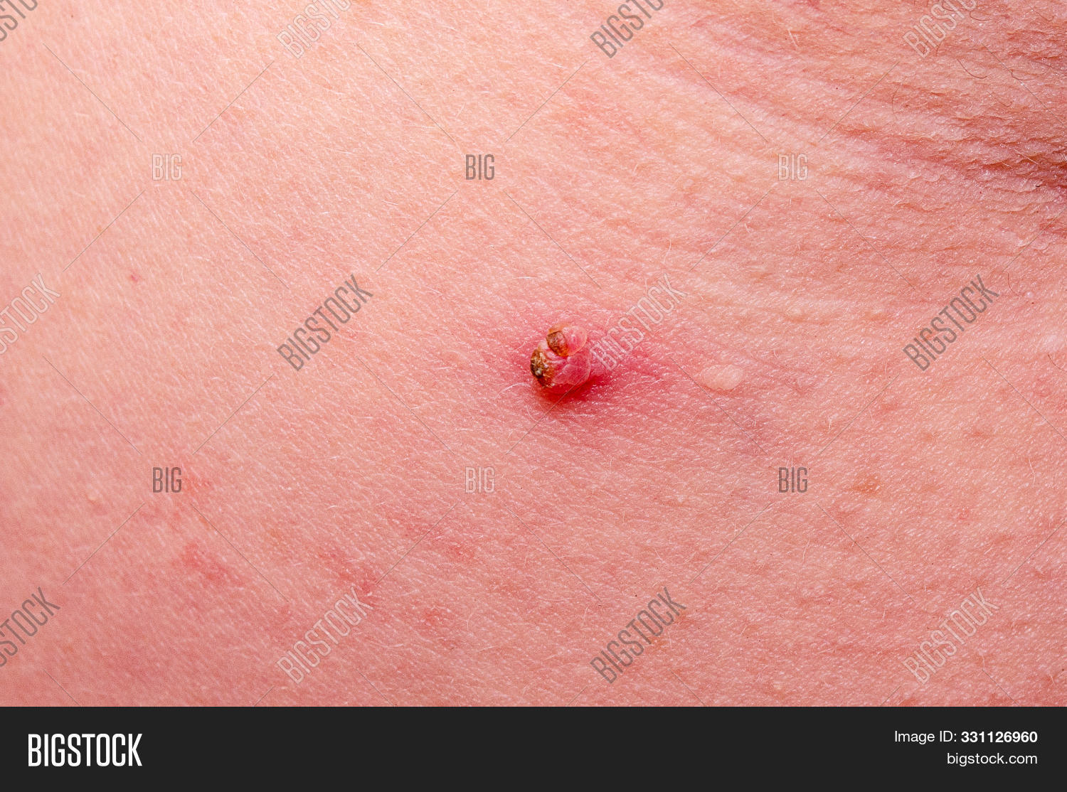 beauty,benign,birthmark,blemish,brown,cancer,checking,closeup,danger,dermatologist,dermatology,diagnosis,doctor,epidermal,health,human,macro,mark,medical,medicine,melanoma,mole,nevus,patient,pigmentation,risk,skin,spot,treatment,woman