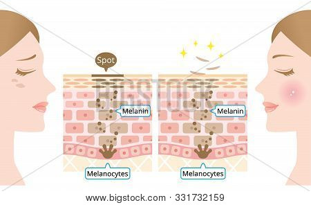 Infographic Skin Cell Turnover Illustration. Melanin And Melanocytes In ...