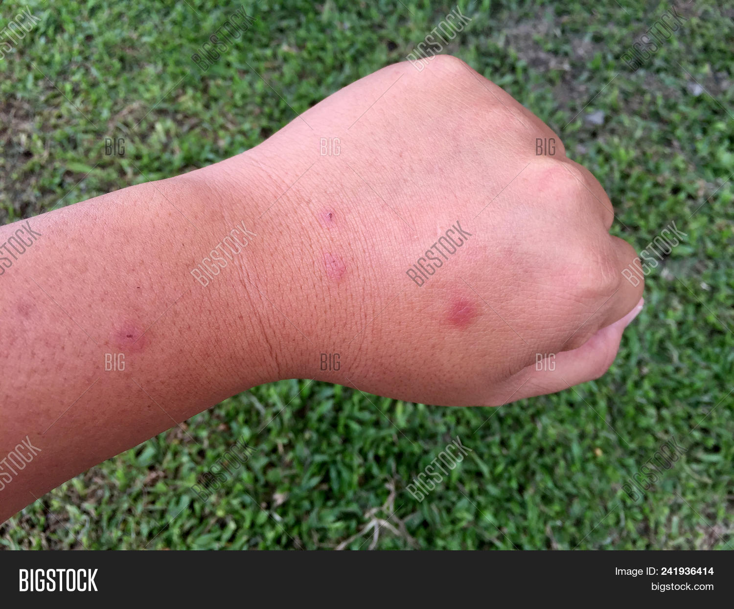 allergic,allergist,allergy,anaphylaxis,arm,baby,background,blood,body,care,close,closeup,condition,contact,dermatitis,dermatology,disease,grass,green,hand,health,healthy,hives,human,hurt,infection,injury,itchy,medical,nature,nettle,outdoor,person,point,raised,rash,reaction,red,scratch,severe,sick,sickness,skin,suffering,symptom,texture,treat,up,urticaria,virus