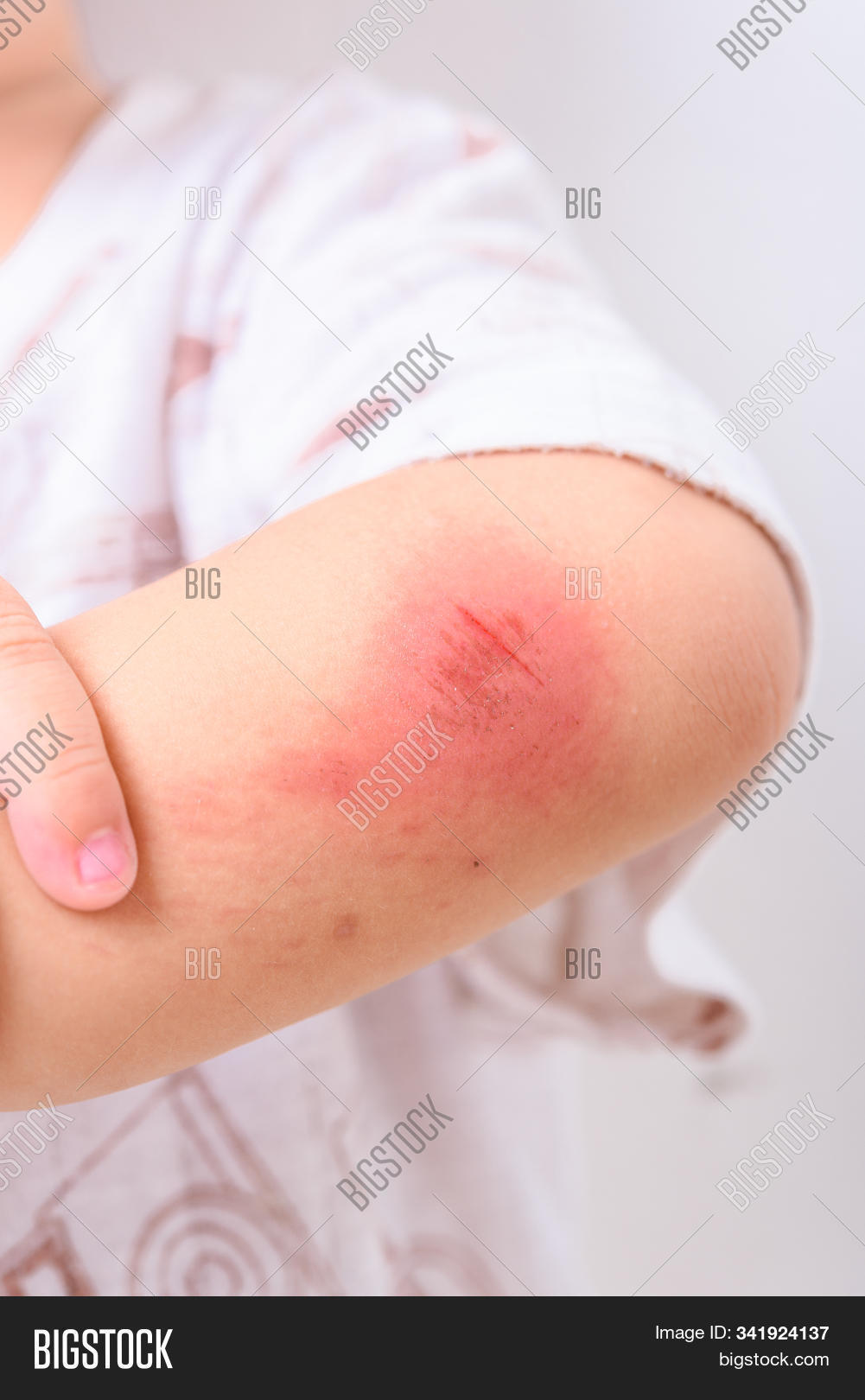 2-3,abrasion,accident,aid,arm,asian,bandage,blood,boy,care,child,clean,concept,cry,dermatitis,dressing,dry,elbow,fall,first,hand,heal,health,hospital,human,hurt,infected,inflammation,injured,injury,itchy,kid,knee,leg,lesion,man,medical,medicine,pain,people,person,plaster,scab,scratch,skin,son,thailand,treatment,wound
