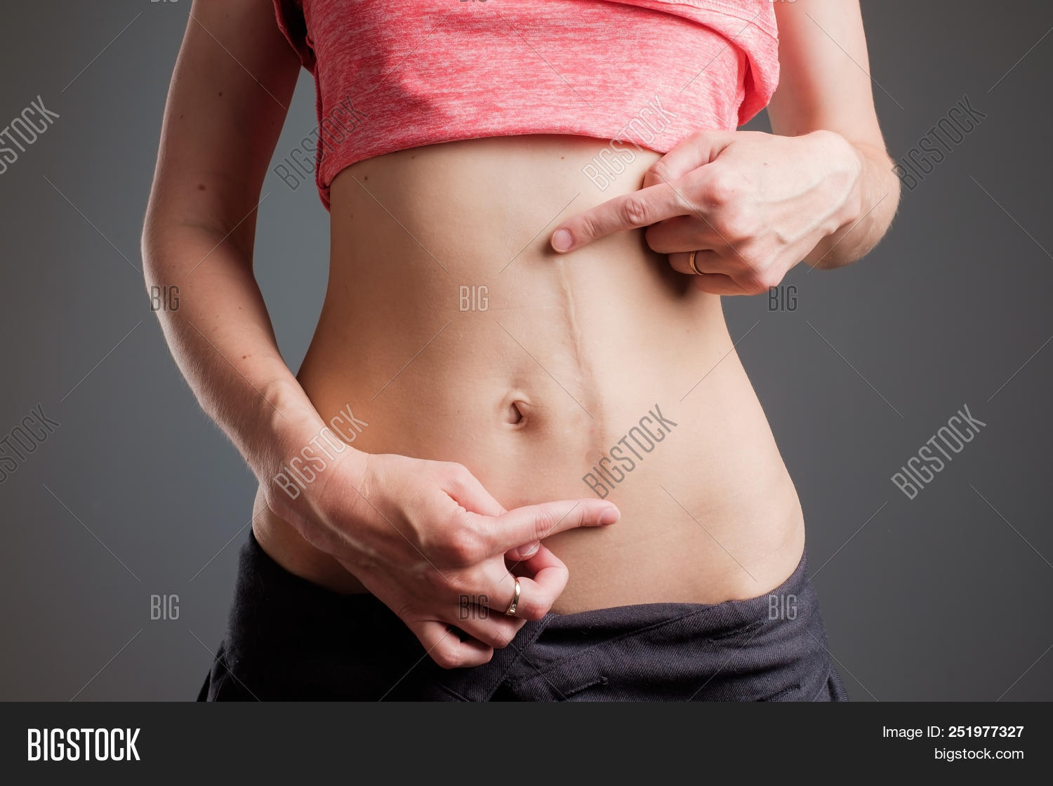 abdomen,abdominal,aesthetic,aesthetically,anatomy,appendicitis,beauty,belly,black,body,break,cancer,cesarean,correction,cyst,diet,distance,female,hand,health,human,injury,intervened,ledge,make,medical,medicine,naked,operation,pain,preparedness,preventive,removal,scar,scarremoval,schlank,screening,section,skin,slim,smoothing,stigma,stomach,surgeon,surgery,tissue,tumor,white,woman