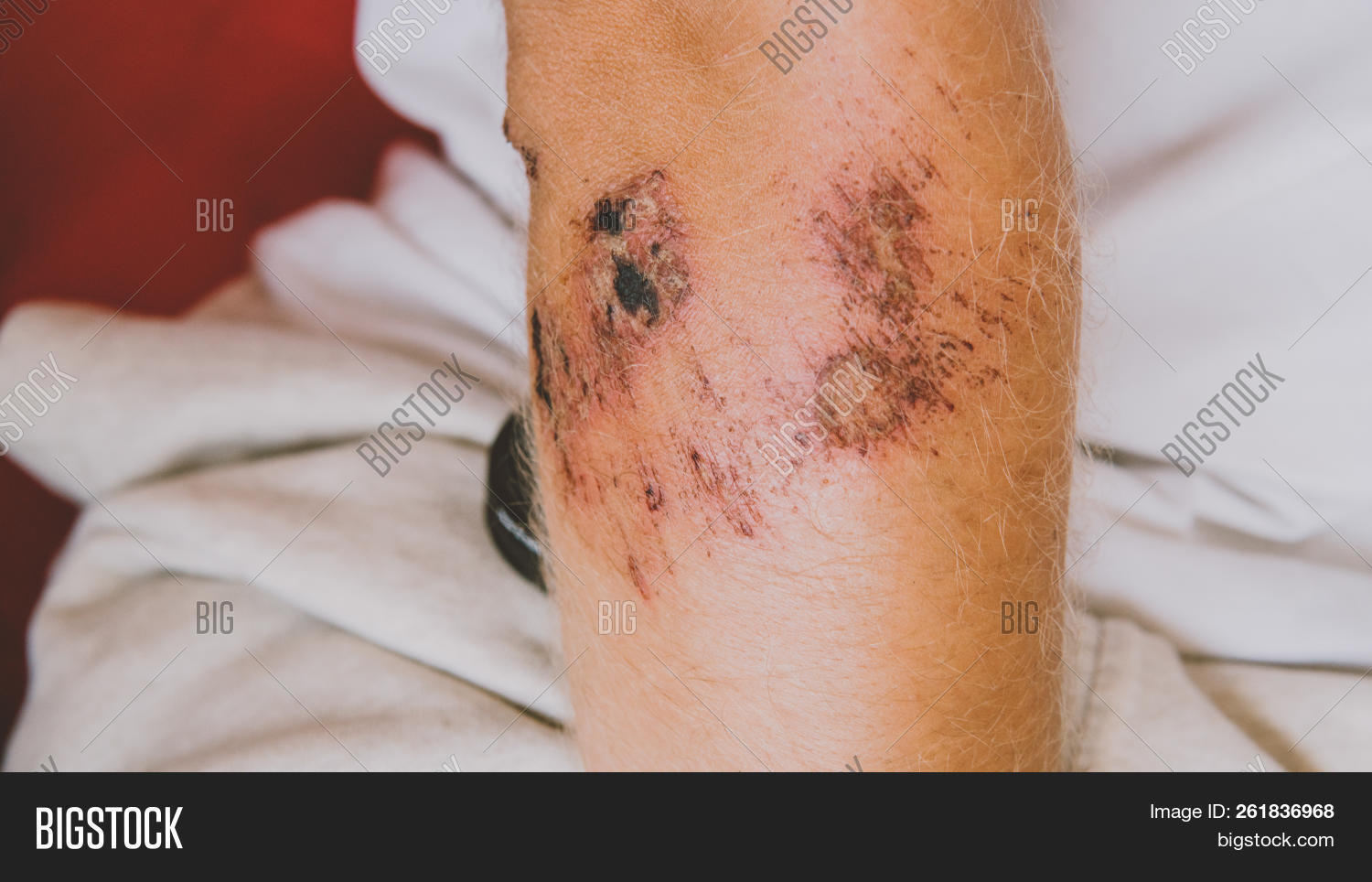 accident,aid,ankle,bandage,bandaged,bandaging,care,emergency,first,foot,health,healthcare,human,hurt,injury,leg,medical,medicine,pain,patient,people,person,white,woman,wound