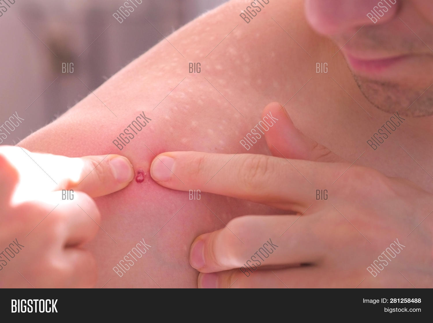 acne,adolescence,allergy,big,blackheads,blemish,care,caucasian,clean,close-up,closeup,cosmetic,cosmetology,dermatology,disease,examination,health,healthy,human,hygiene,infection,inspection,irritation,itching,man,men,mole,pimple,pore,problem,pus,red,redness,scar,shoulder,skin,skincare,spot,squeeze,treatment,ugly,white,young