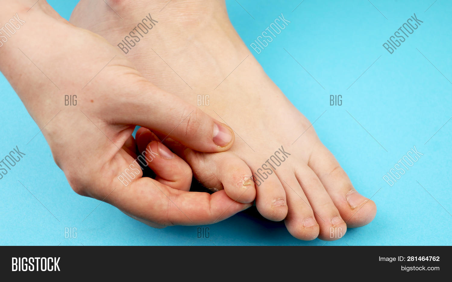 Fungus Of Foot Closeup, Isolated On Blue Background. The Concept