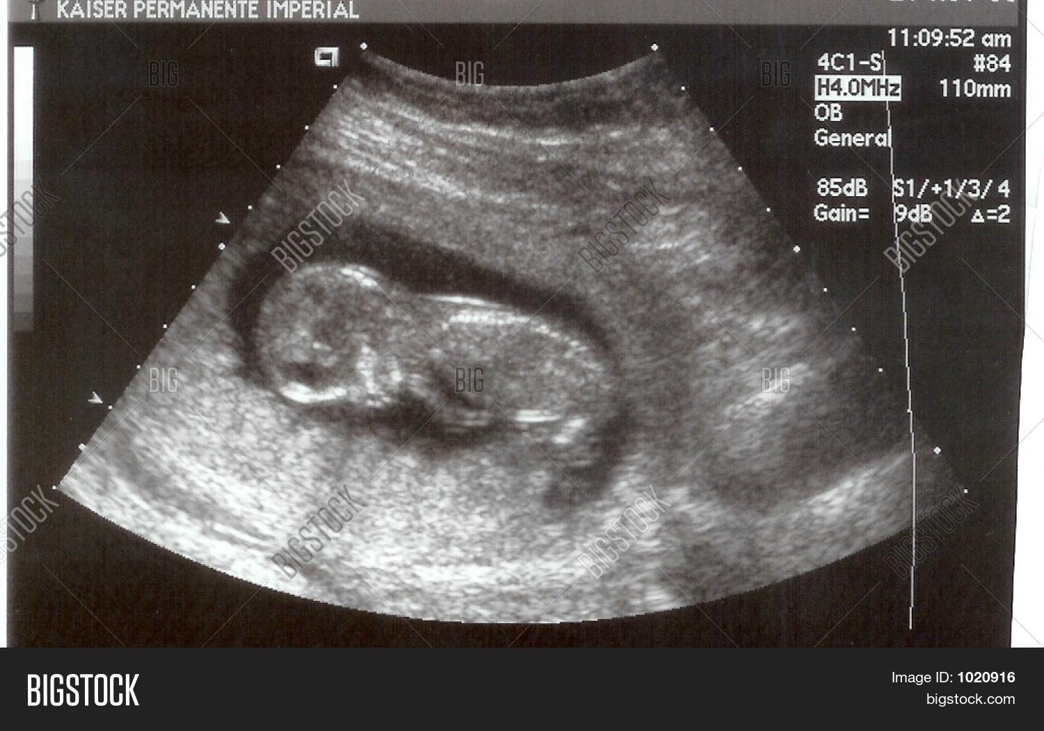 abortion,abstract,baby,beginning,belly,birth,body,born,boy,cherish,child,develop,doctor,dream,expect,expecting,family,fetus,girl,grow,growing,hope,husband,inner,life,love,miracle,months,new,nine,obgyn,pregnancy,pregnant,protect,real,sex,sleep,sleeping,sweet,ultrasonic,ultrasound,unborn,unspoiled,view,waiting,wife,woman,womb,wonder