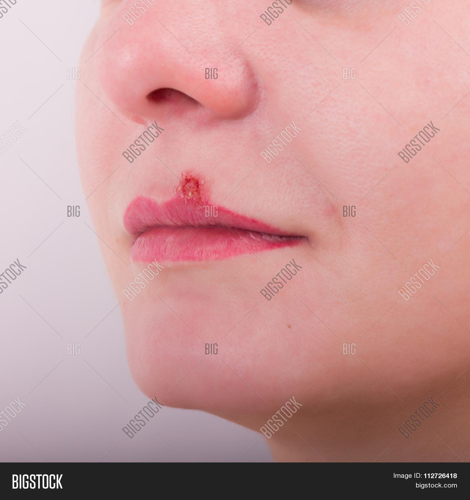 affected,anatomy,beautiful,blisters,burned,chapped,condition,crusted,dermatology,disease,disgusting,dry,face,fever,girl,gross,health,healthcare,herpes,herpis,illness,infection,injury,irritation,lips,little,lush,medical,medicine,mouth,nasal,painful,patient,person,physical,place,problem,rash,redness,scabbing,scabs,shine,skin,stubble,suffering,swollen,treatment,virus,woman