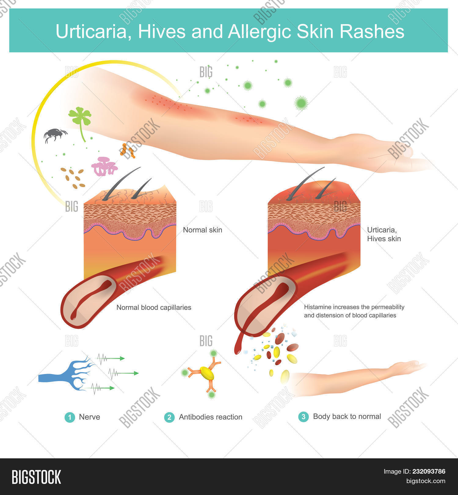 Urticaria, Hives And Allergic Skin Rashes Is A Kind Of Skin Rash With