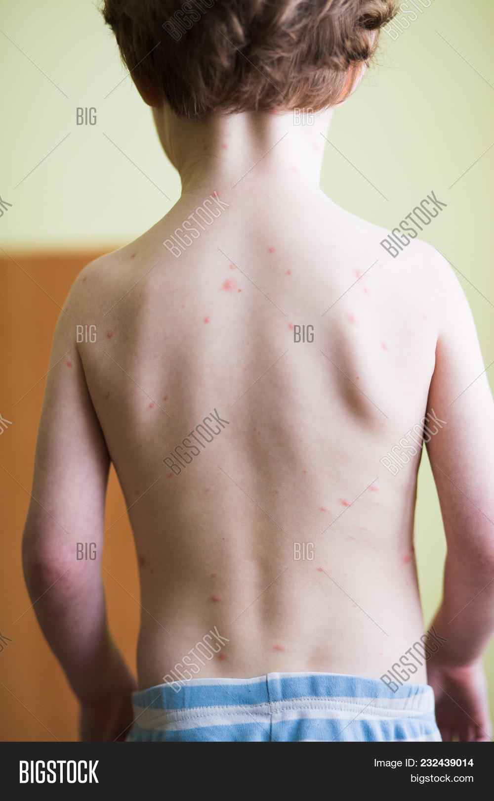 allergic,allergy,baby,bite,blister,blistering,body,boy,caucasian,chicken,chickenpox,child,childhood,contagious,covered,crying,dermatitis,dermatology,disease,face,feeling,health,healthcare,home,ill,illness,immunesystem,immunity,infant,infection,infectiousdisease,itchy,kid,medical,portrait,pox,protection,rash,scan,scratch,sick,sickness,skin,smallpox,spots,symptoms,toddler,unhappy,unwell,vaccination