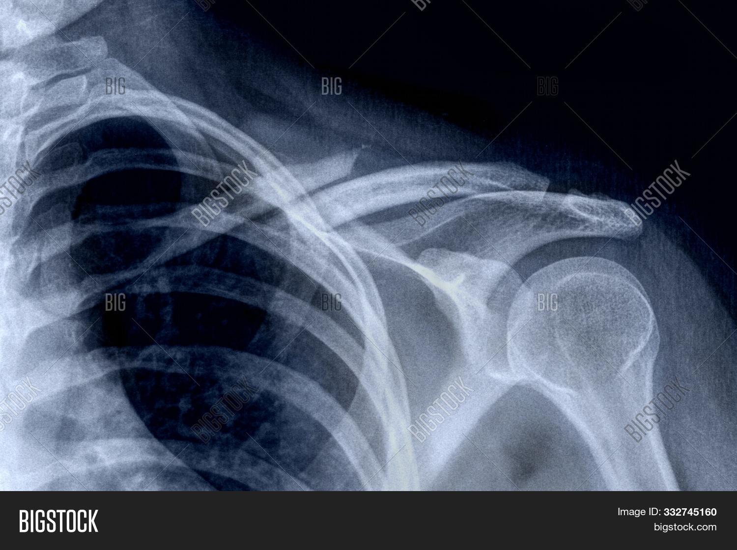 Articulación,Escapula,Medicinal,Radiografía,anatomía,articulaciones,articulación,cirugía,clavicula,clavícula,del,enfermedad,enfermo,esqueleto,examinar,fractura,fármacos,golpe,herido,hombre,hombro
Hombro,hospital,hueso,humano,humero,inmovilización,lesión,mujer,operación,osteoporosis,paciente,radiación,radiografía,radiología,rayos,revisión,salud,tomografía,trauma,vertebras,x