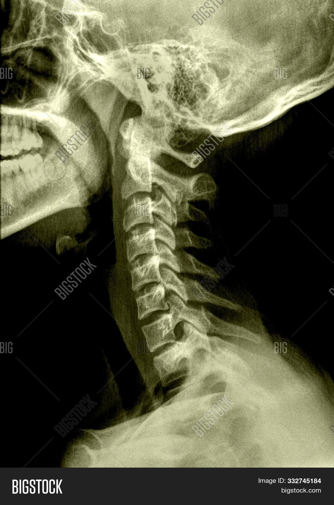 Radiografia Lateral De Las Vertebras Del Cuello image & stock photo ...