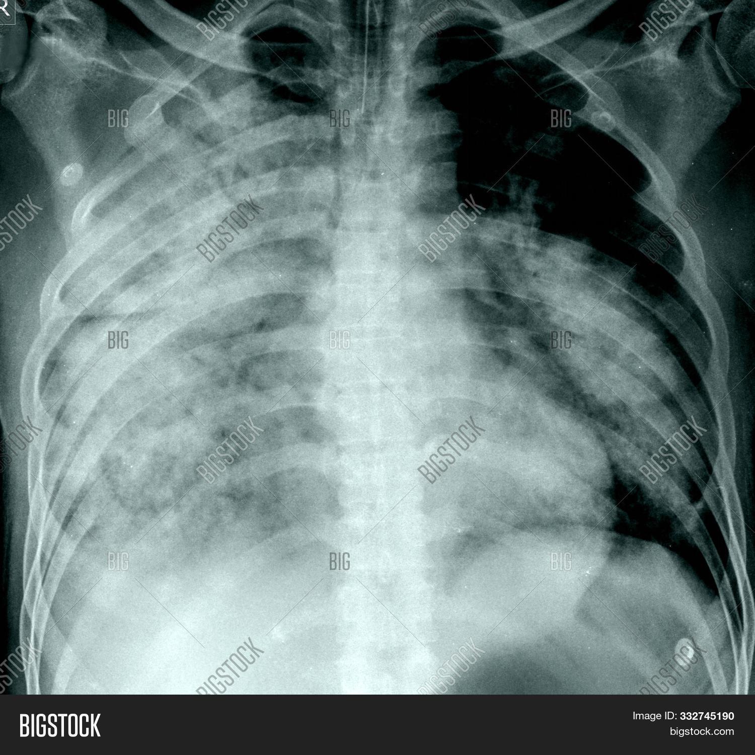 anatomía,articulaciones,articulación,corazón,costillas,diafragma,dorsales,enfermedad,enfermo,esqueleto,esternón,examinar,fractura,fumador,fármacos,hospital,hueso,humana,mediastino,medicinal,neumia,osteoporosis,paciente,pulmones,pulmón,radiación,radiografía,radiología,revisión,salud,trauma,tórax,vertebras,x