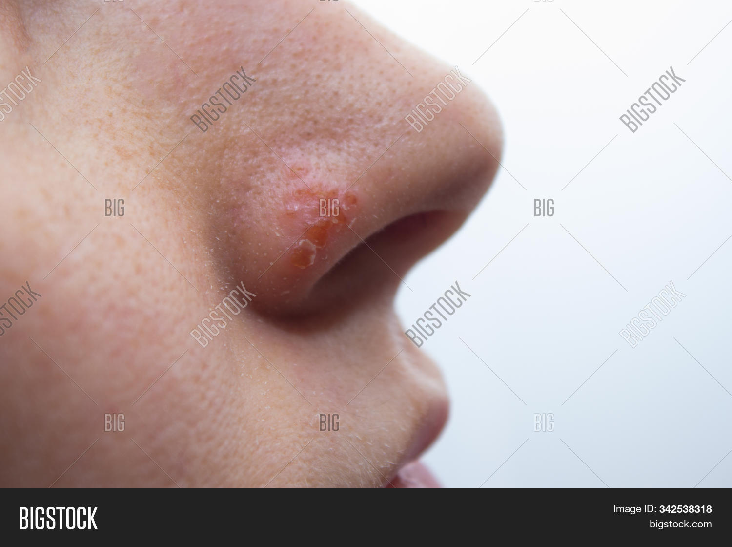 adult,affected,beautiful,beauty,blister,boy,care,caucasian,clear,closeup,cold,cosmetology,cream,crusted,dermatology,disease,disgusting,face,fever,girl,health,herpes,illness,infection,inflammation,lip,man,medical,mouth,mustache,natural,nose,pain,person,problem,pure,scabbing,simplex,skin,sore,swollen,touching,treatment,virus,white,woman,young