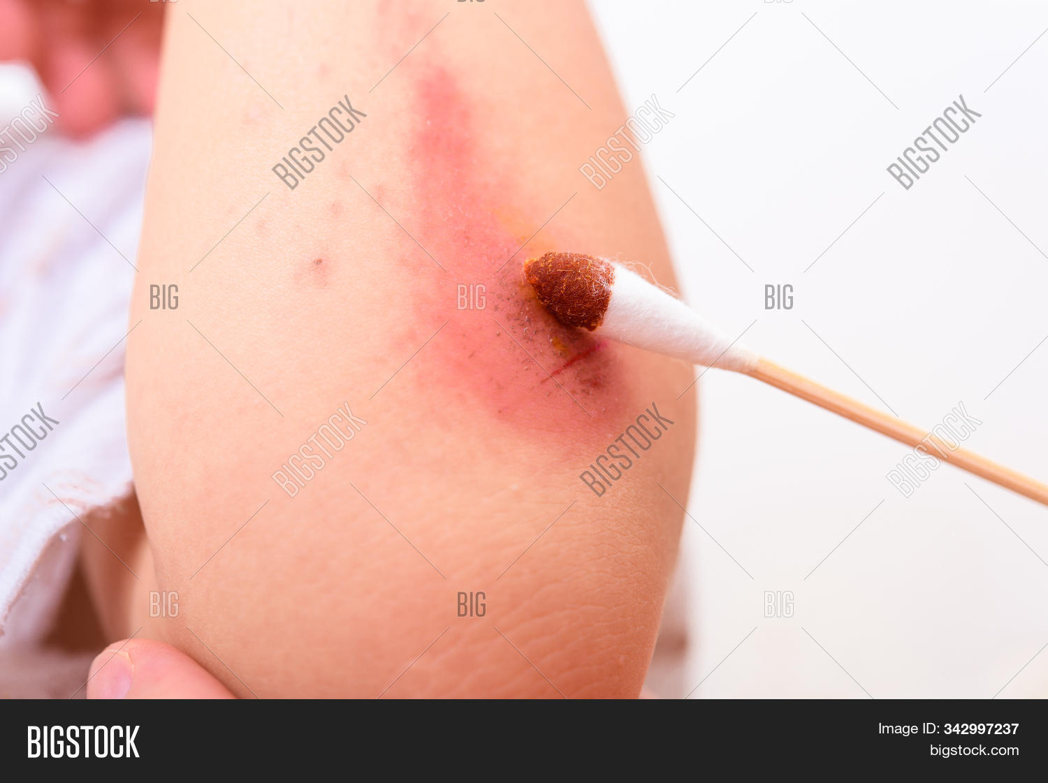 2-3,abrasion,accident,aid,arm,asian,bandage,blood,boy,care,child,clean,concept,cry,dermatitis,dressing,dry,elbow,fall,first,hand,heal,health,hospital,human,hurt,infected,inflammation,injured,injury,itchy,kid,knee,leg,lesion,man,medical,medicine,pain,people,person,plaster,scab,scratch,skin,son,thailand,treatment,wound