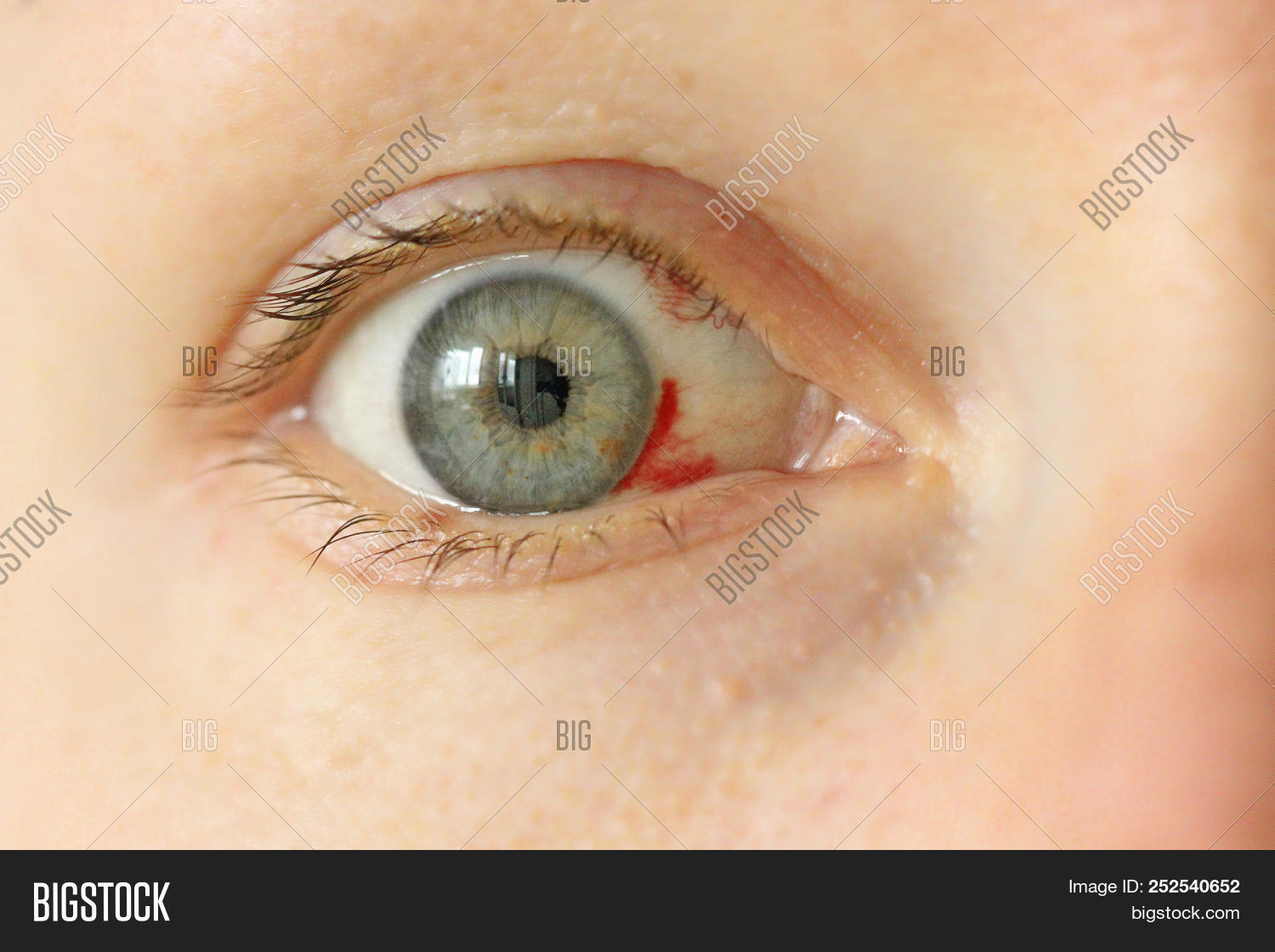 Bloodshot Eye Woman With Burst Blood Vessel In Eye Very Red Bloody