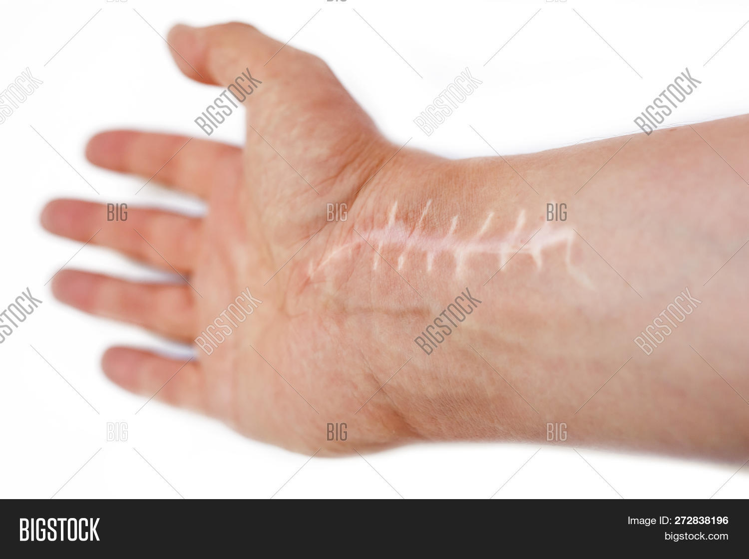 accident,arm,body,bone,broken,cicatrice,cicatrix,cut,damage,damaged,disease,diseased,emergency,fist,flesh,fracture,freckles,hand,health,hospital,hurt,incision,injured,injury,isolated,laceration,limb,macro,medical,medicine,operation,pain,painful,palm,patient,scab,scar,scarring,sew,skin,sore,stitch,suicide,surgery,surgical,suture,trauma,treatment,wound,wrist