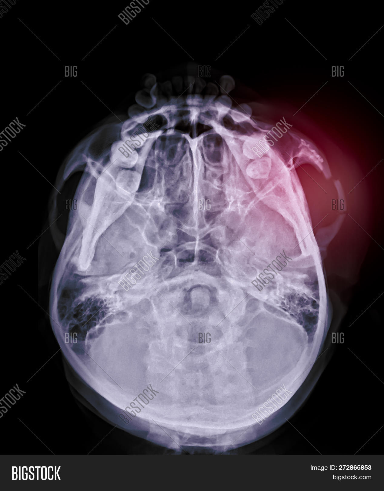accident,base,bone,brain,cerebrovascular,computed,diagnosis,diagnostic,dislocation,disorder,doctor,emergency,examination,face,facial,film,fracture,frontal,head,health,human,incident,injury,jaw,jaw-bone,mandible,mandibular,maxilla,maxillary,medical,mouth,nasal,orbit,pain,paranasal,patient,plate,radiography,roentgenogram,scan,screws,sinus,skeleton,skull,submentovertex,tooth,transparent,trauma,x-ray