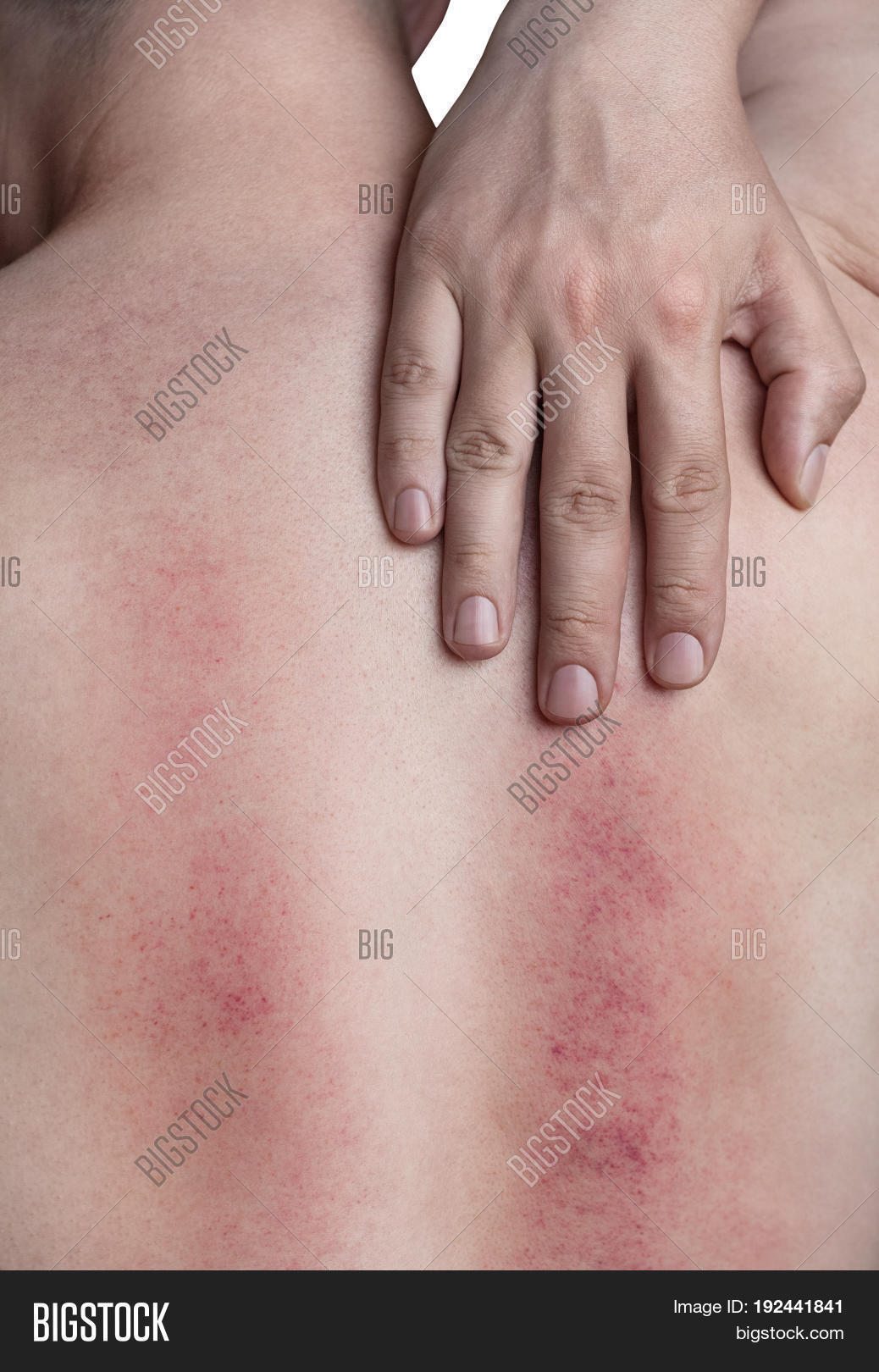 Sun,allergic,allergy,back,bacterial,bite,blister,blood,blow,bruise,burn,capillary,chemicals,clinic,dermatitis,dermatology,disease,effect,excitability,exposure,gore,hematoma,hospital,hypothermia,infection,inflammation,injury,insect,itching,lichen,male,medicine,overheating,pain,patient,rash,reaction,red,redness,scratch,sensitivity,side,skin,spine,spots,stain,stroke,symptom,telangiectasia,treatment,vein,vessel