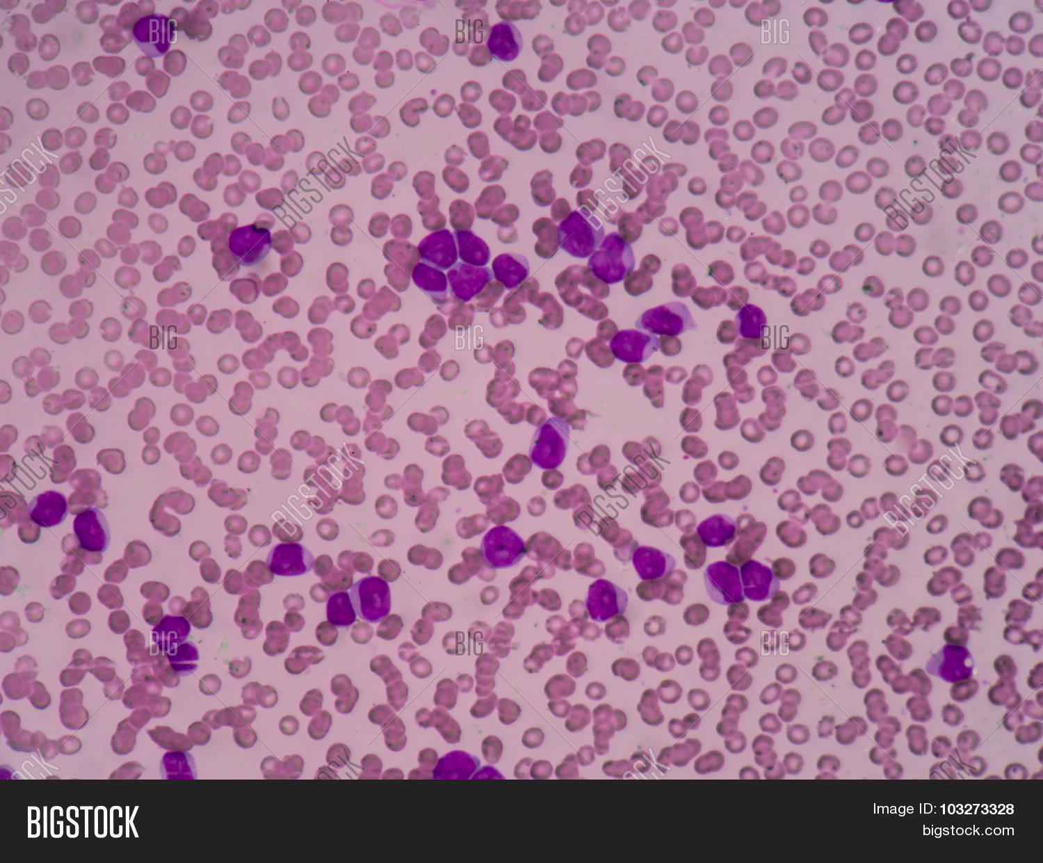 Bone Marrow: Myeloblasts With Auer Rods Seen In Acute Myeloid Leukemia ...