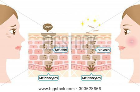 Mechanism Of Skin Cell Turnover Illustration. Melanin And Melanocytes ...