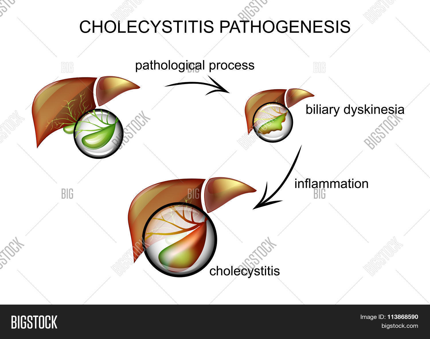 acidity,bile,bilious,bitterness,bladder,bubble,burning,cholagogue,cholecystitis,choleretic,cholic,clinic,clinical,diagnosis,digestion,digestive,duct,egd,examination,gall,gallbladder,gastroenterologist,gastroenterology,gastrointestinal,heartburn,hepar,hepatic,hepatite,human,indigestion,inflame,inflammation,inflammatory,liver,medical,medicine,ray,roentgen,scan,scanning,science,sticker,surgery,system,therapy,tract,ultrasonic,ultrasonography,ultrasound,x-ray