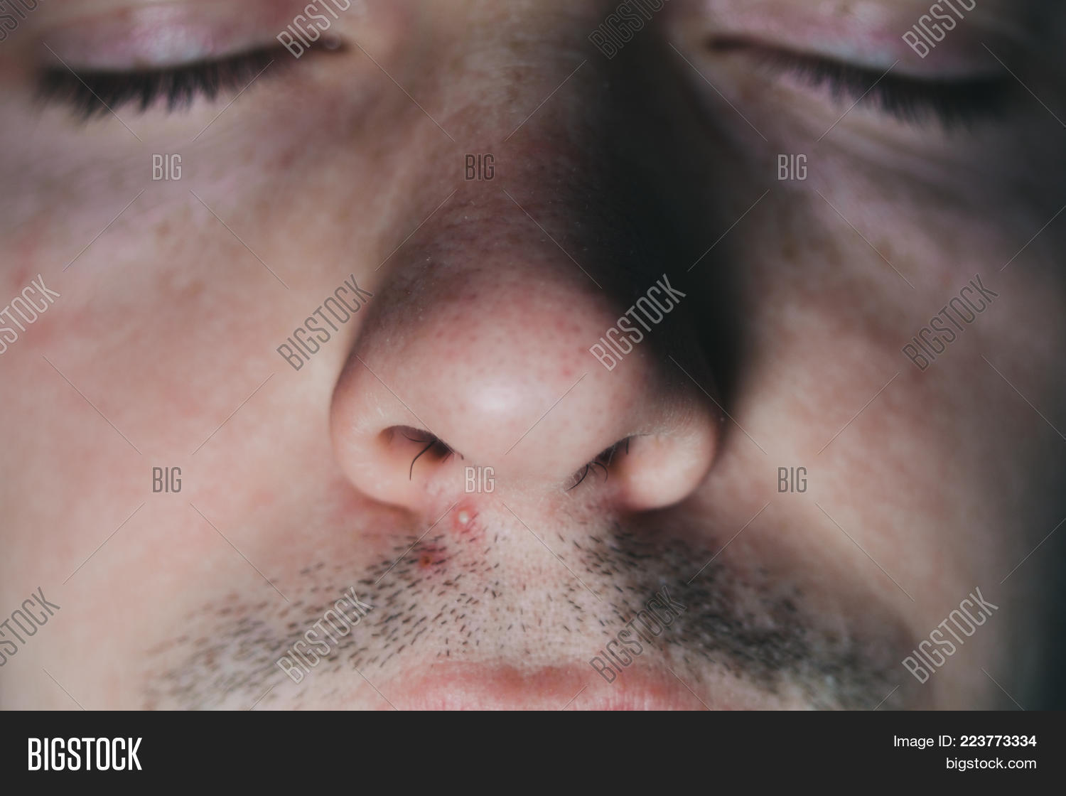 abscess,acne,blackhead,blemish,blister,boil,bump,carbuncle,care,closeup,dermatology,detail,dot,face,facial,hair,head,health,huge,hygiene,infection,inflammation,large,lip,macro,man,medical,mouth,mustache,nose,nostrils,painful,pimple,problem,pustule,skin,spot,teenage,teenager,young,youth