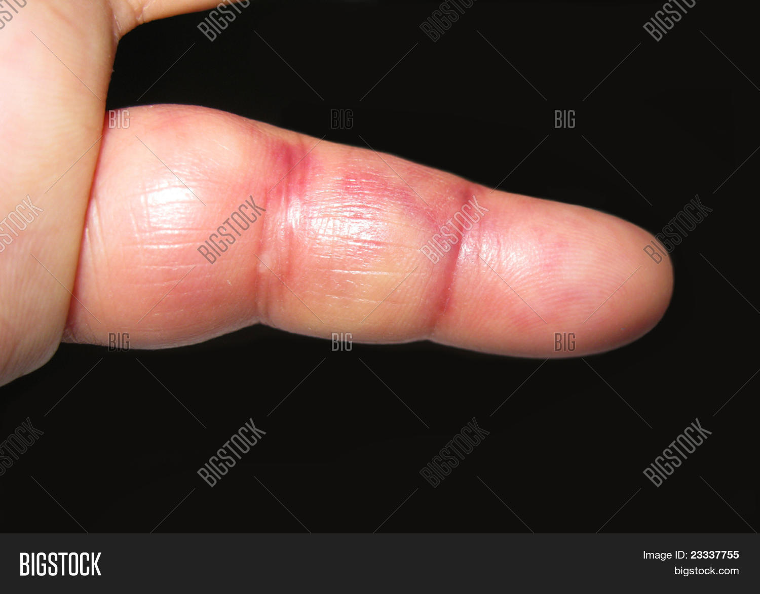 accident,alignment,black,bleed,blue,bone,bruised,clinic,coloration,crush,damage,discolored,dislocation,ecchymosis,fifth,finger,fractured,hand,health,healthcare,hospital,hyperextension,hyperflexed,impact,inflamed,inflammation,injury,joint,left,ligament,little,manipulation,medical,misaligned,pain,phalanges,phalanx,purple,red,reduction,skin,soft,subdermal,subluxation,swell,tender,tense,tissue,trauma