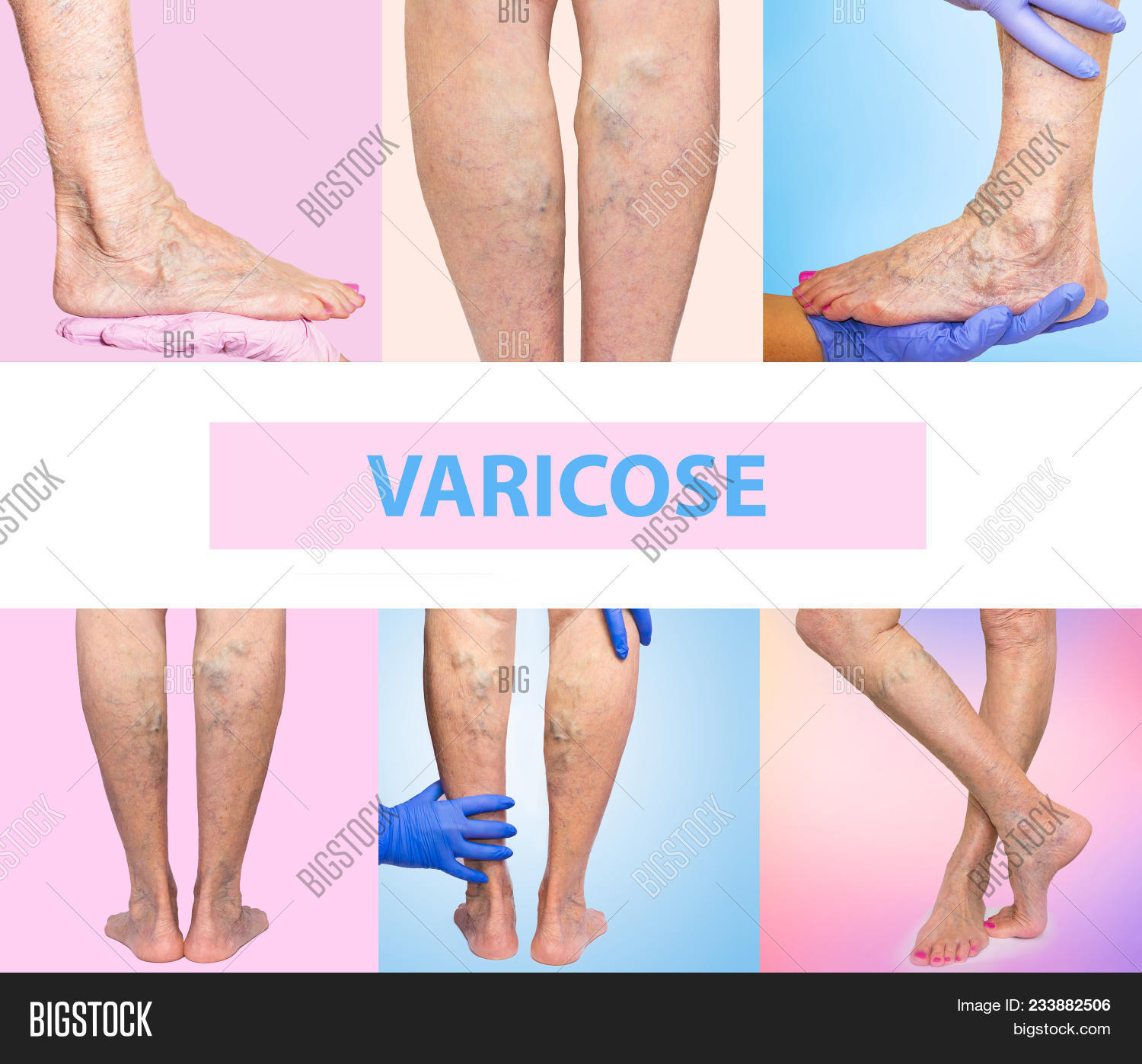 adult,aesthetic,age,background,blood,body,care,circulatory,collage,compression,disease,eczema,edema,elder,elderly,enlarged,foot,health,healthcare,hematology,illness,leg,medical,medicine,old,older,pain,painful,patient,people,person,phlebotomy,problem,senior,skin,skincare,spider,surgery,swelling,texture,thickening,thrombosis,tortuous,twisted,ulceration,varices,varicose,vascular,vein,woman