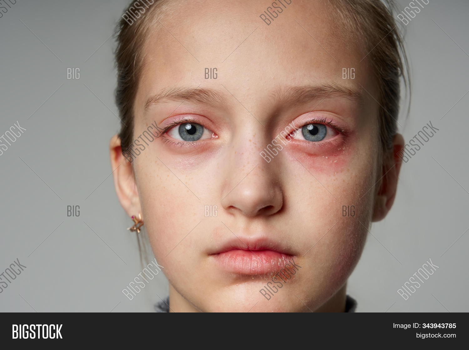 allergen,allergic,allergy,bad,caucasian,child,close,closeup,dermatitis,dermatological,dermatology,disease,eyes,face,girl,gray,health,ill,immune,immunity,infection,inflammation,isolated,itch,lips,medical,mouth,nose,one,portrait,problem,rash,reaction,red,redness,scratch,sensitive,sick,sickness,skin,sweater,system,treatment,view,white,young